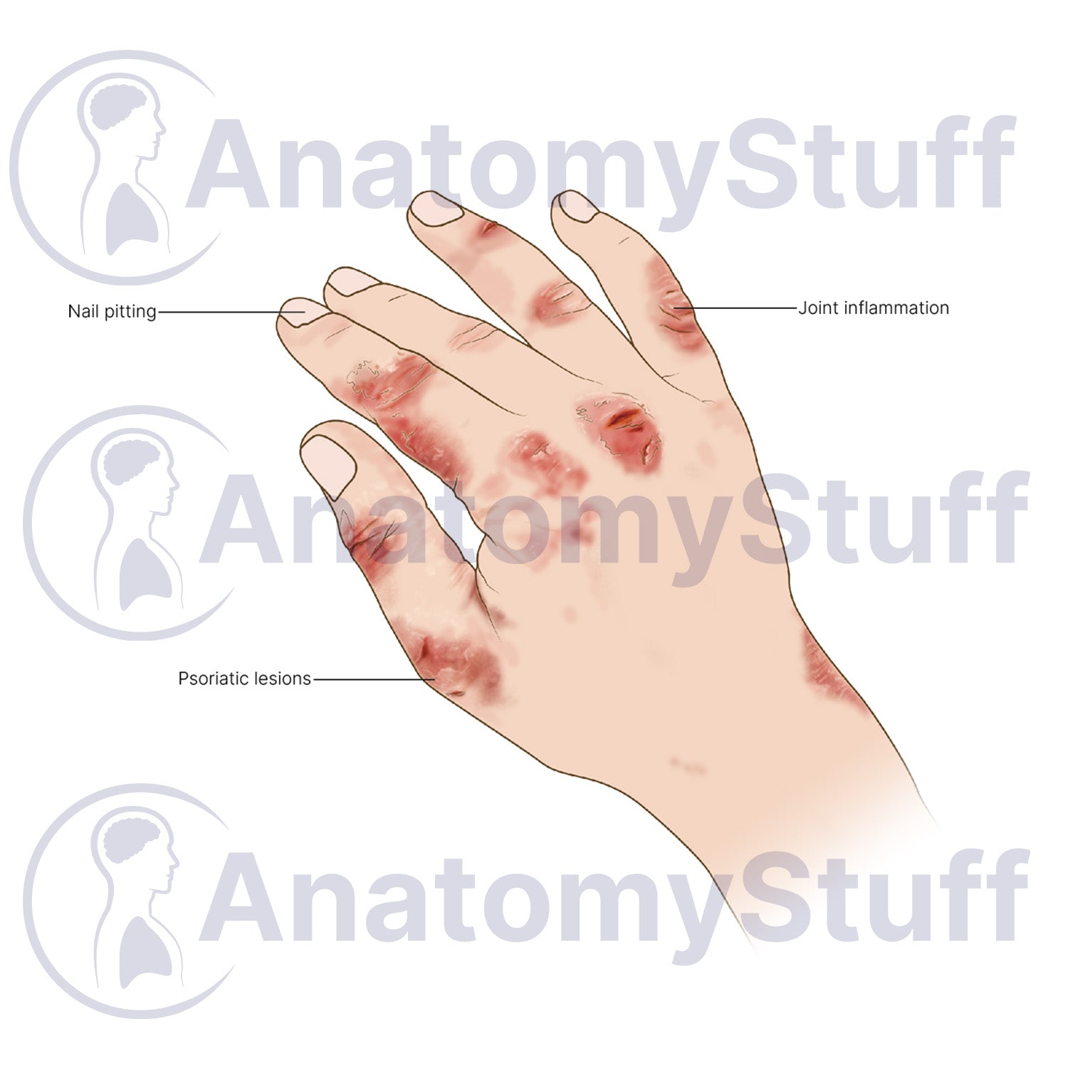 Psoriatic Arthritis Illustration