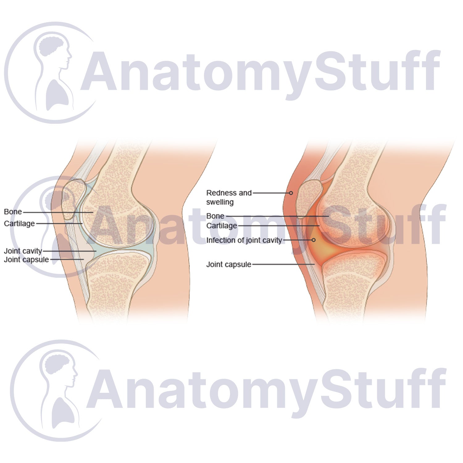 Septic Arthritis Illustration