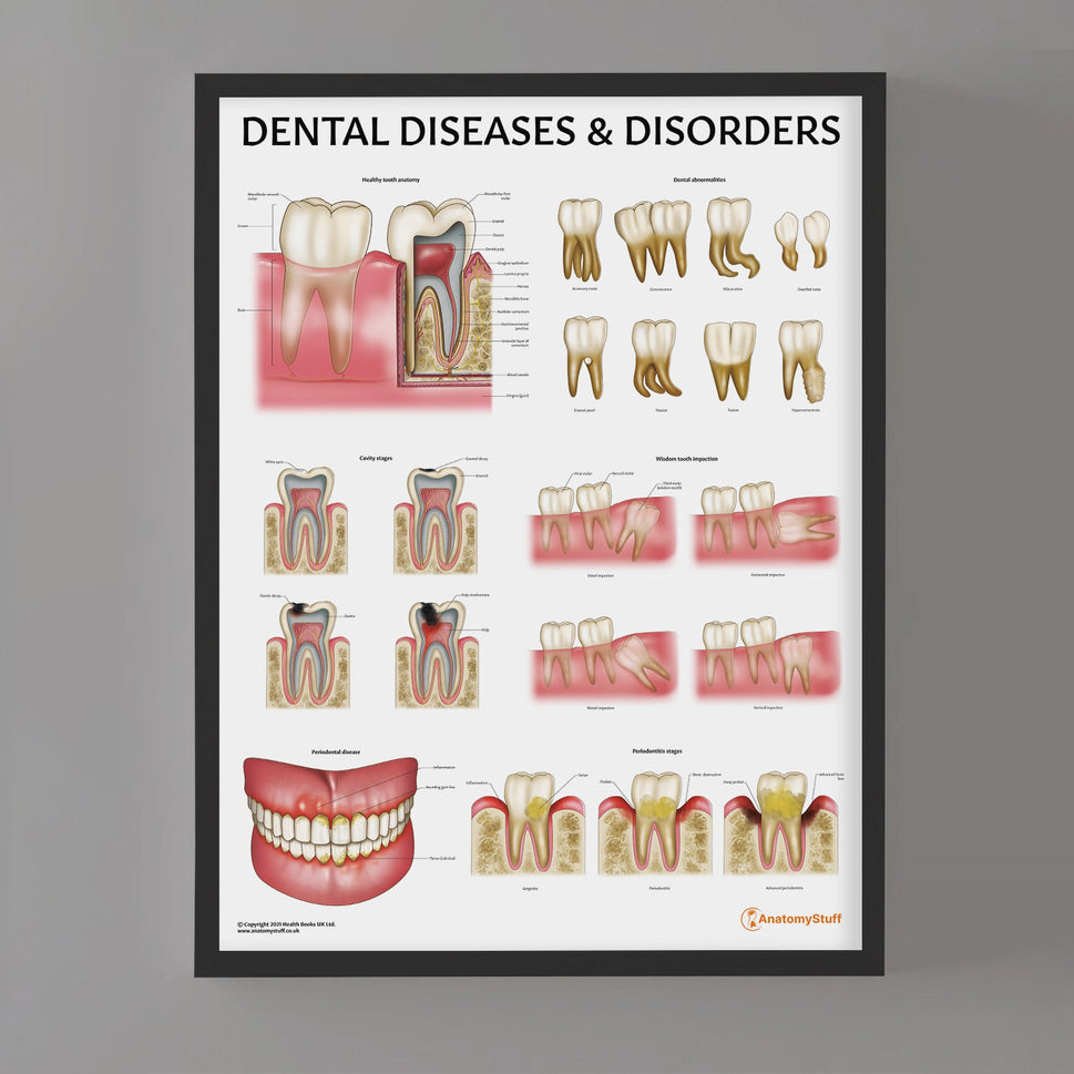Dental Diseases & Disorders Chart / Poster