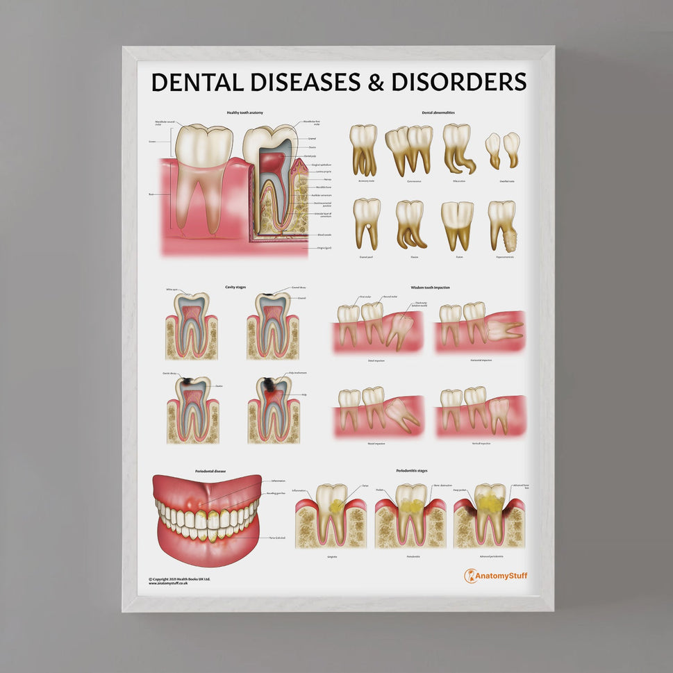 Dental Diseases & Disorders Chart / Poster