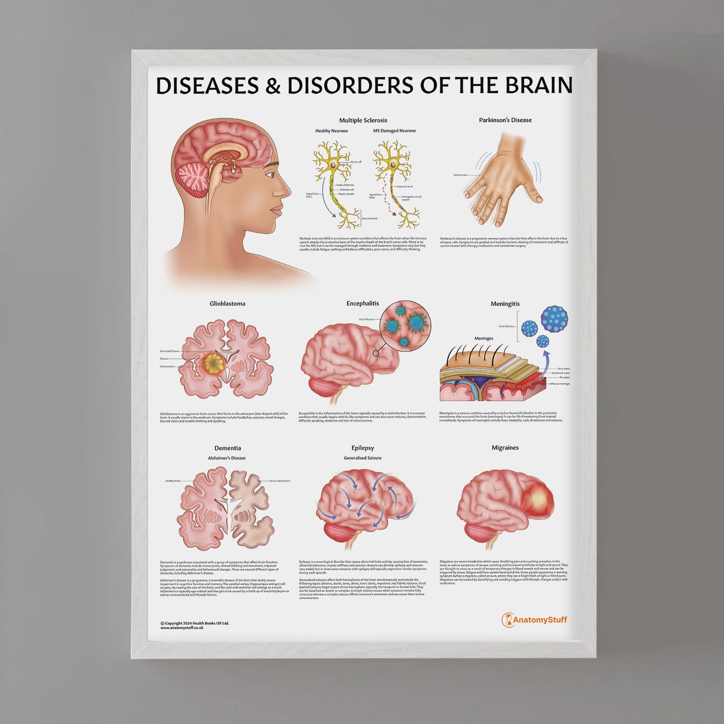 Diseases & Disorders of the Brain Chart / Poster