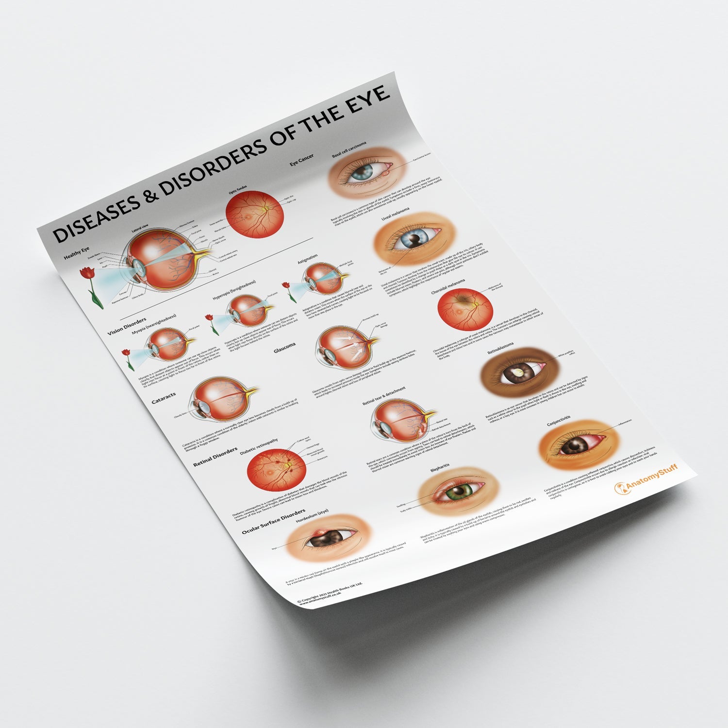 Diseases and Disorders of the Eye Chart / Poster