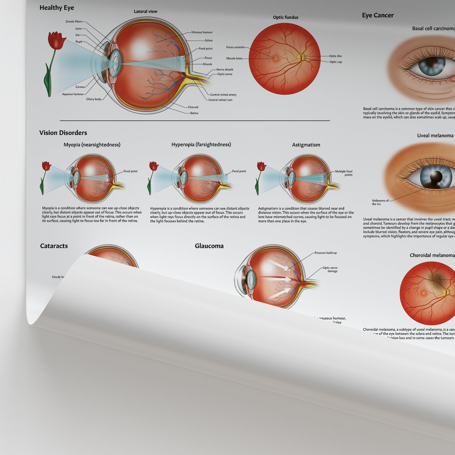 Diseases and Disorders of the Eye Chart / Poster