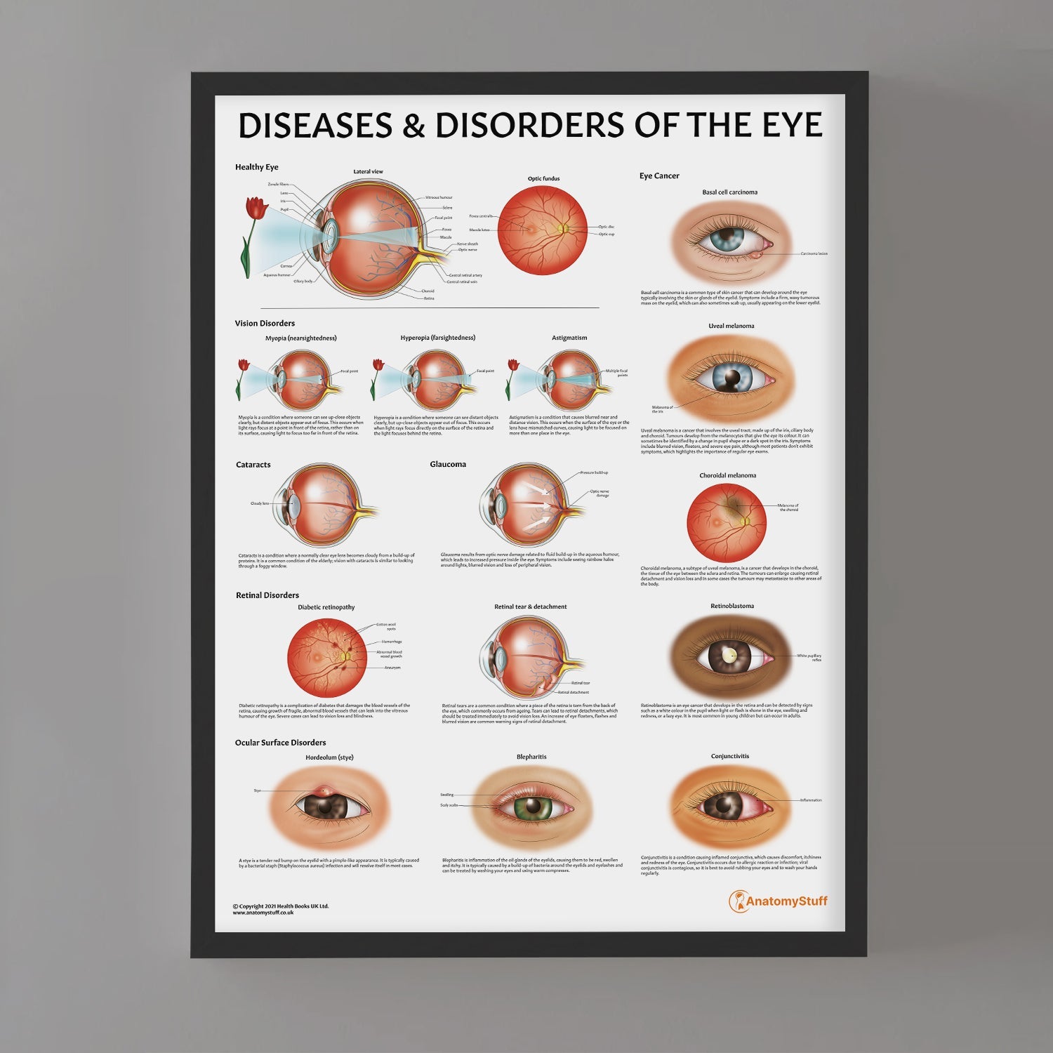 Diseases and Disorders of the Eye Chart / Poster