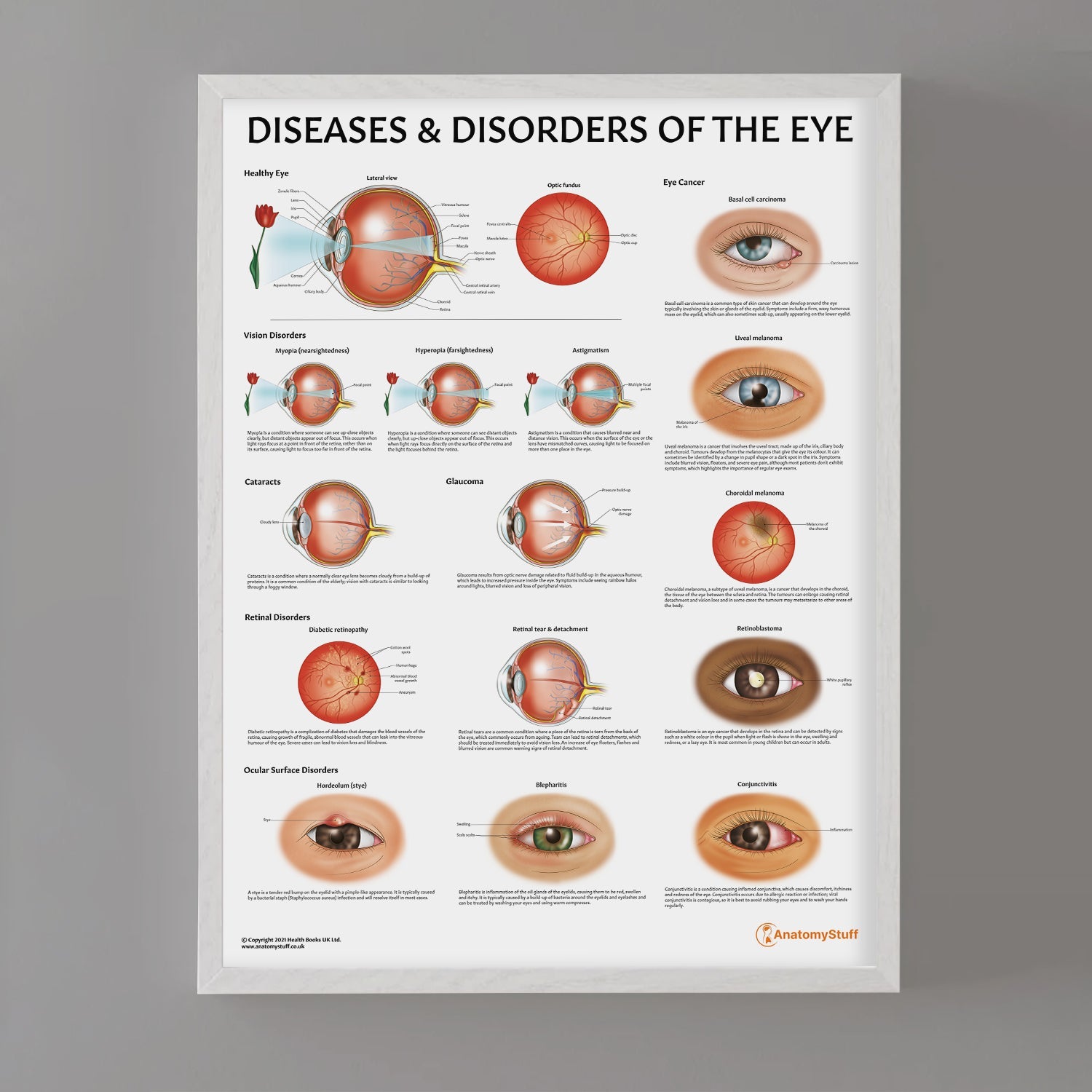 Diseases and Disorders of the Eye Chart / Poster