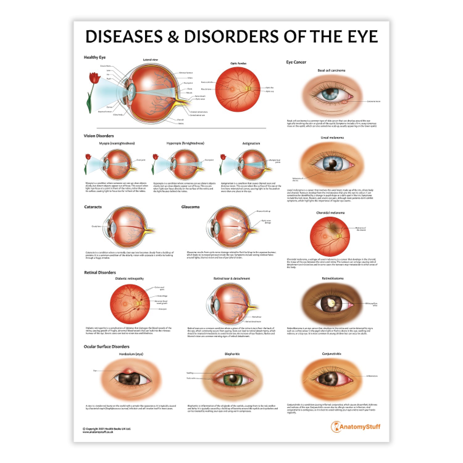 Diseases and Disorders of the Eye Chart / Poster