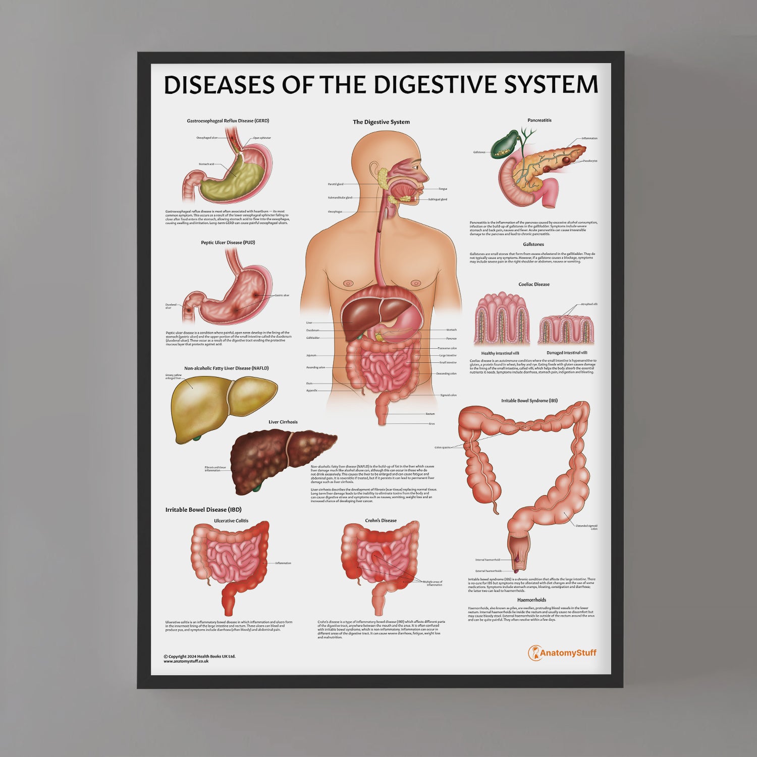 Diseases of the Digestive System Chart / Poster