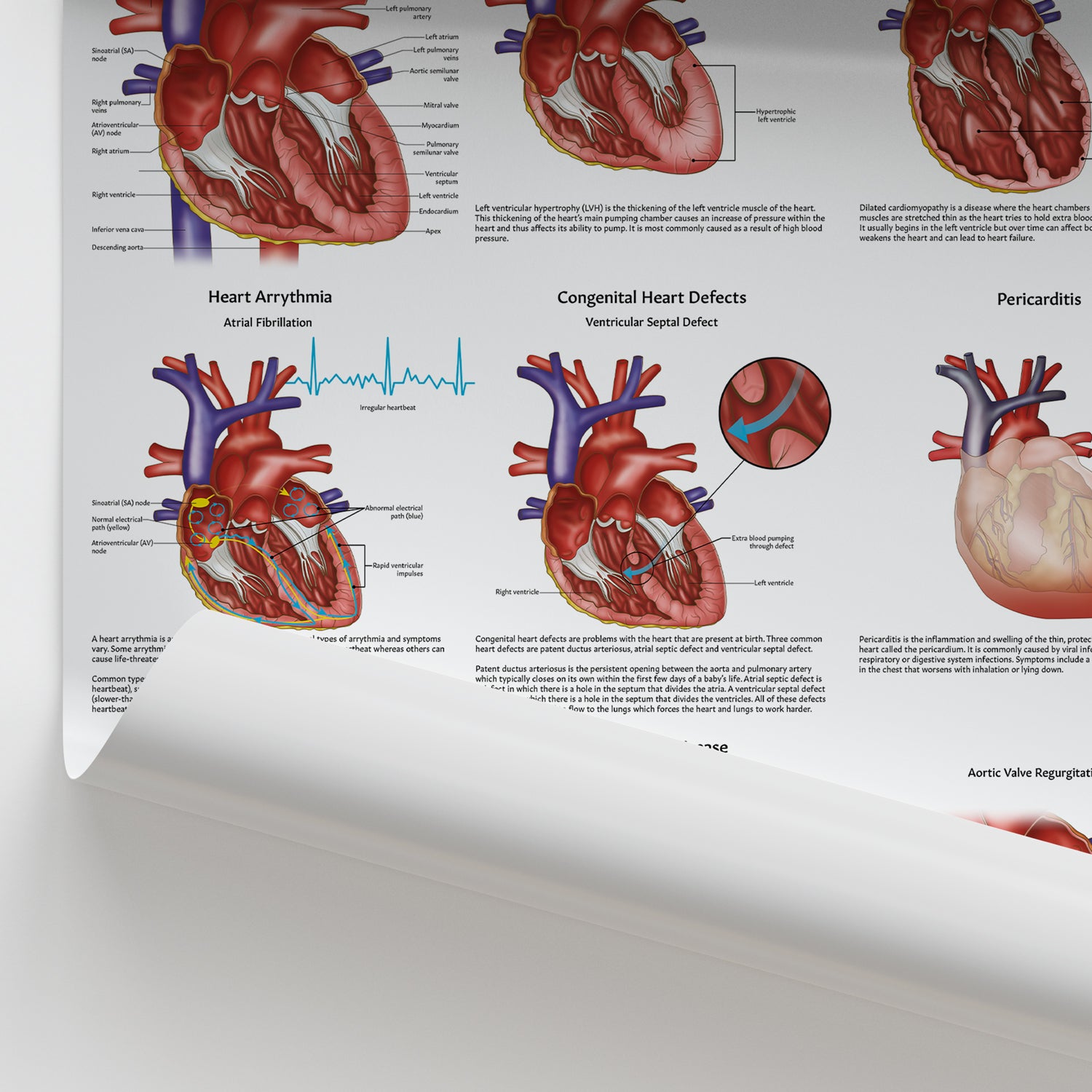 Diseases of the Heart Chart / Poster