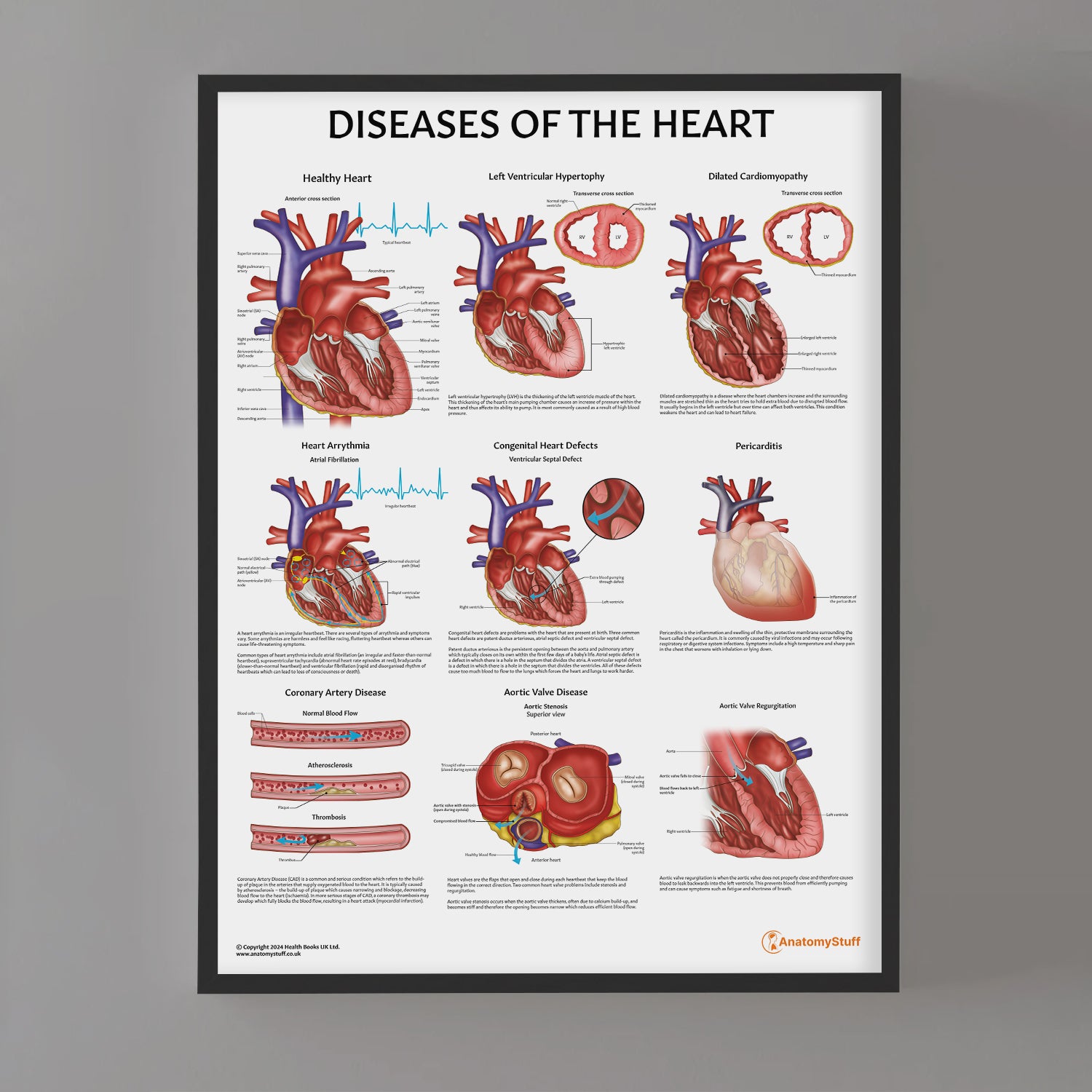 Diseases of the Heart Chart / Poster