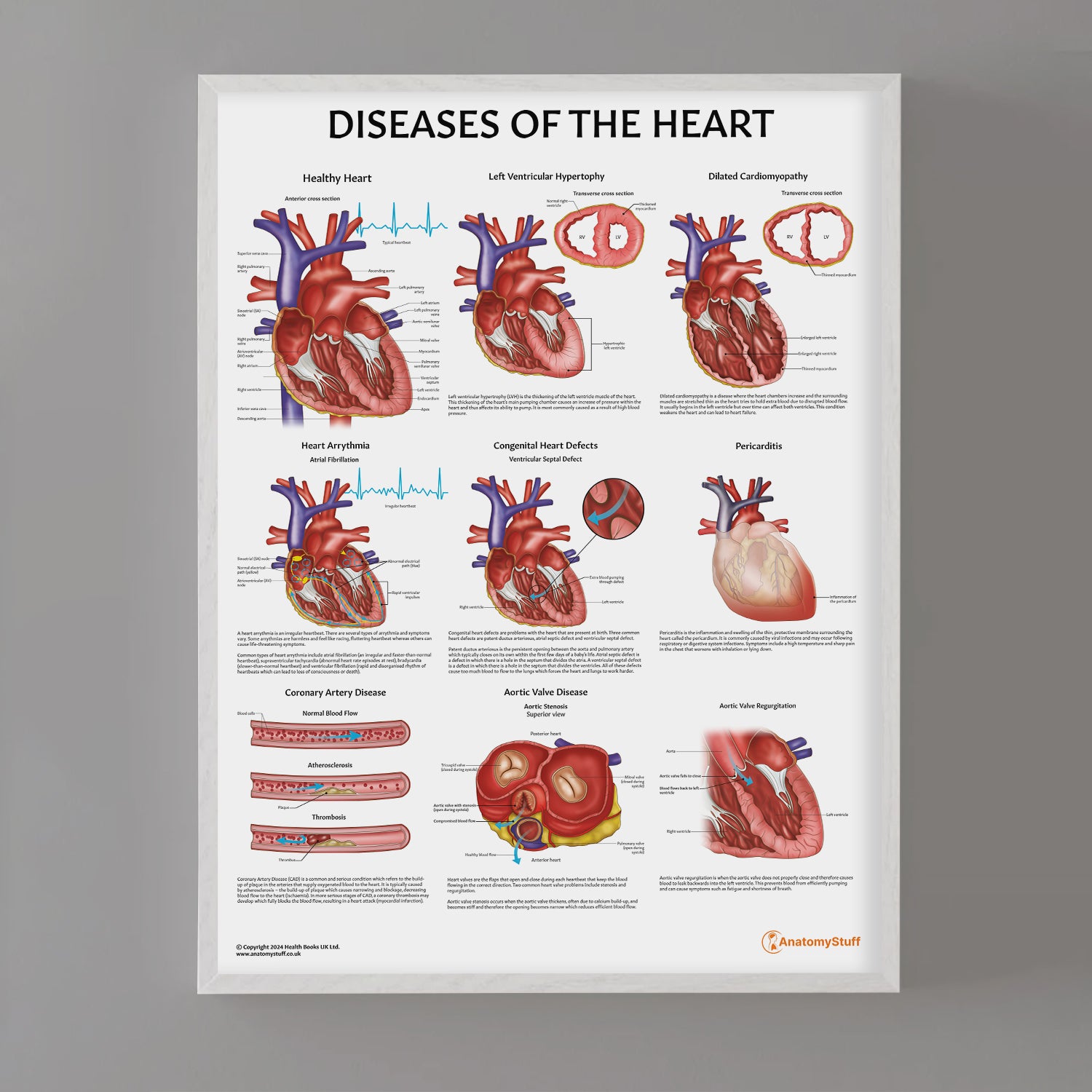 Diseases of the Heart Chart / Poster