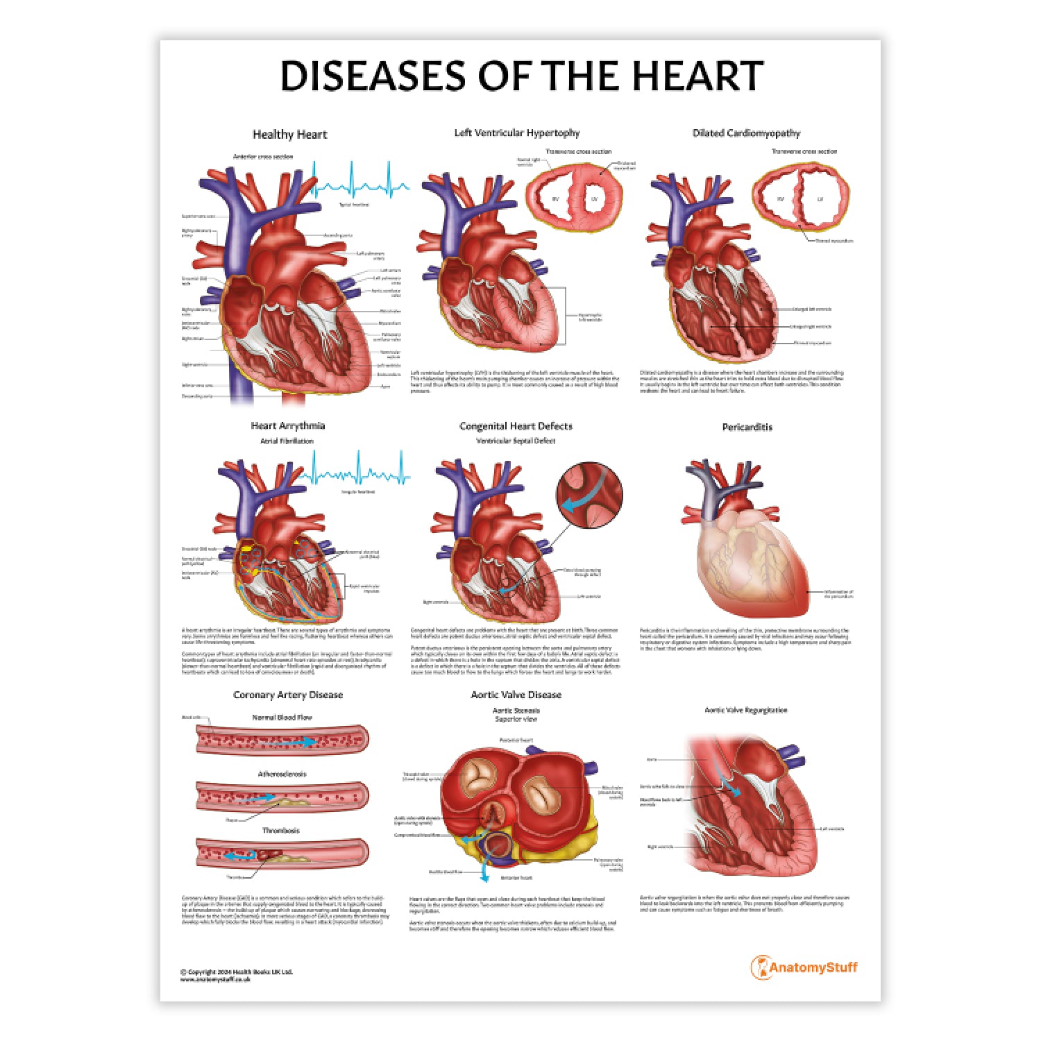 Diseases of the Heart Chart / Poster