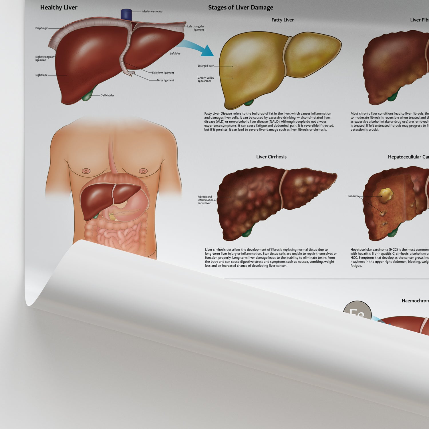 Diseases of the Liver Chart / Poster