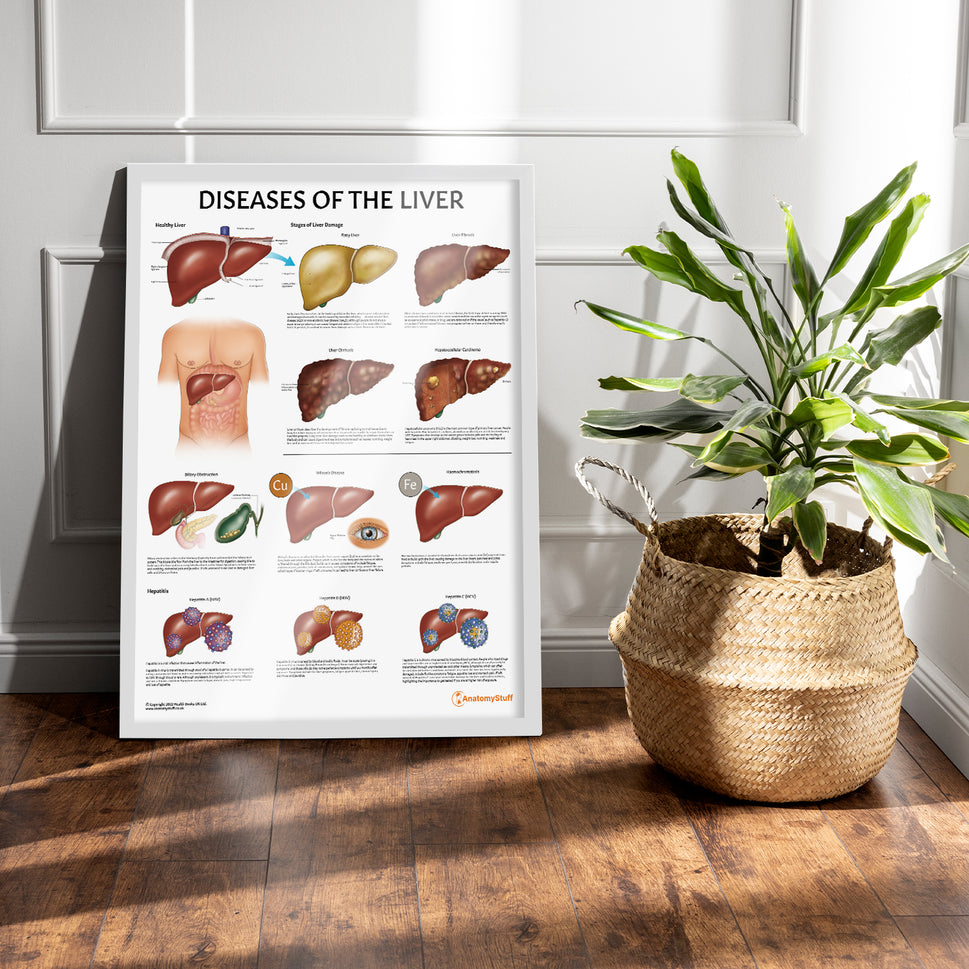 Diseases of the Liver Chart / Poster