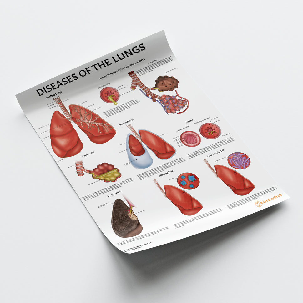 Diseases of the Lungs Chart / Poster