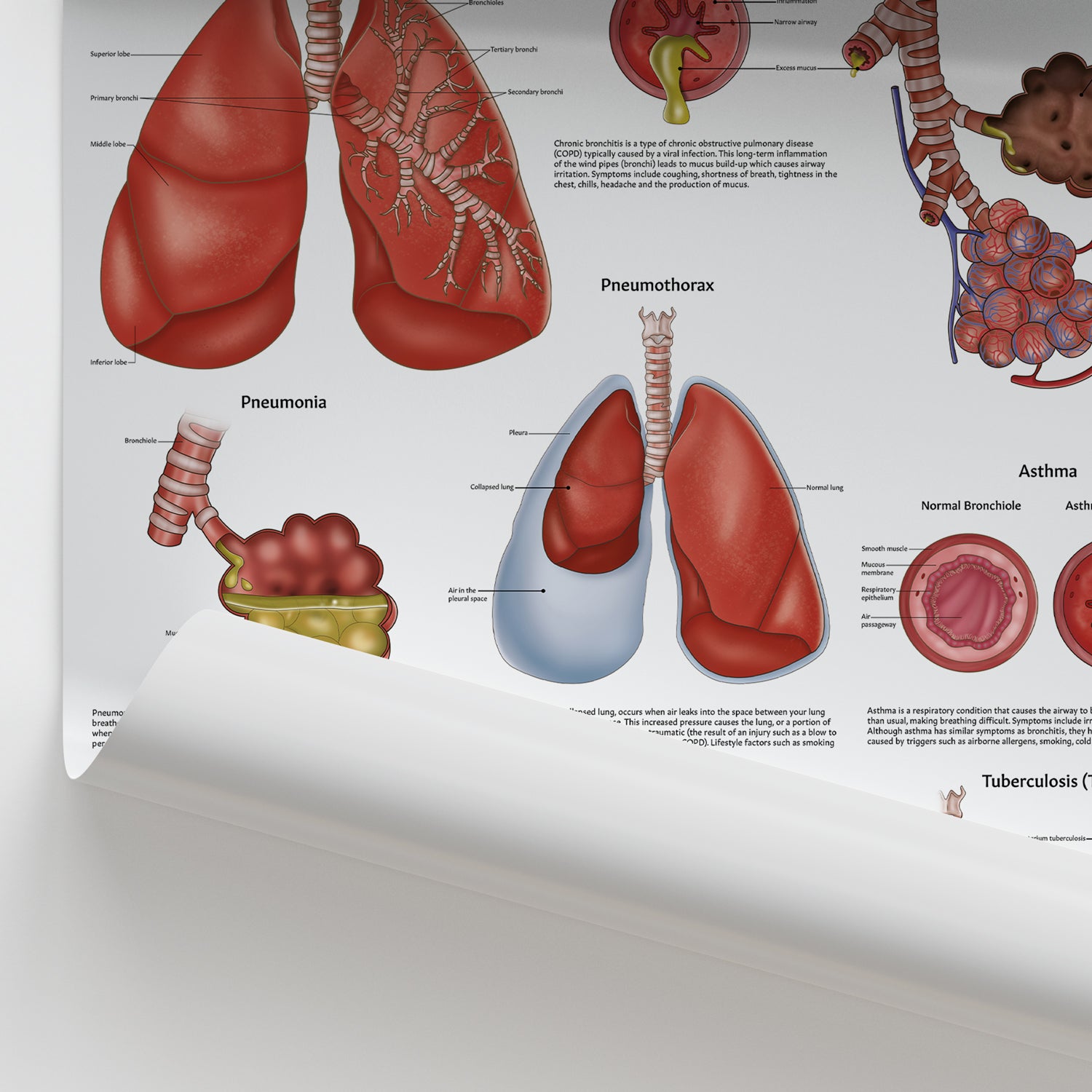 Diseases of the Lungs Chart / Poster