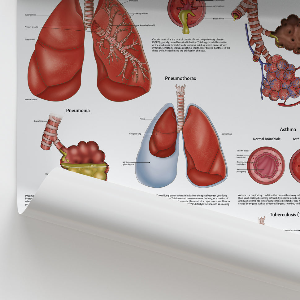 Diseases of the Lungs Chart / Poster