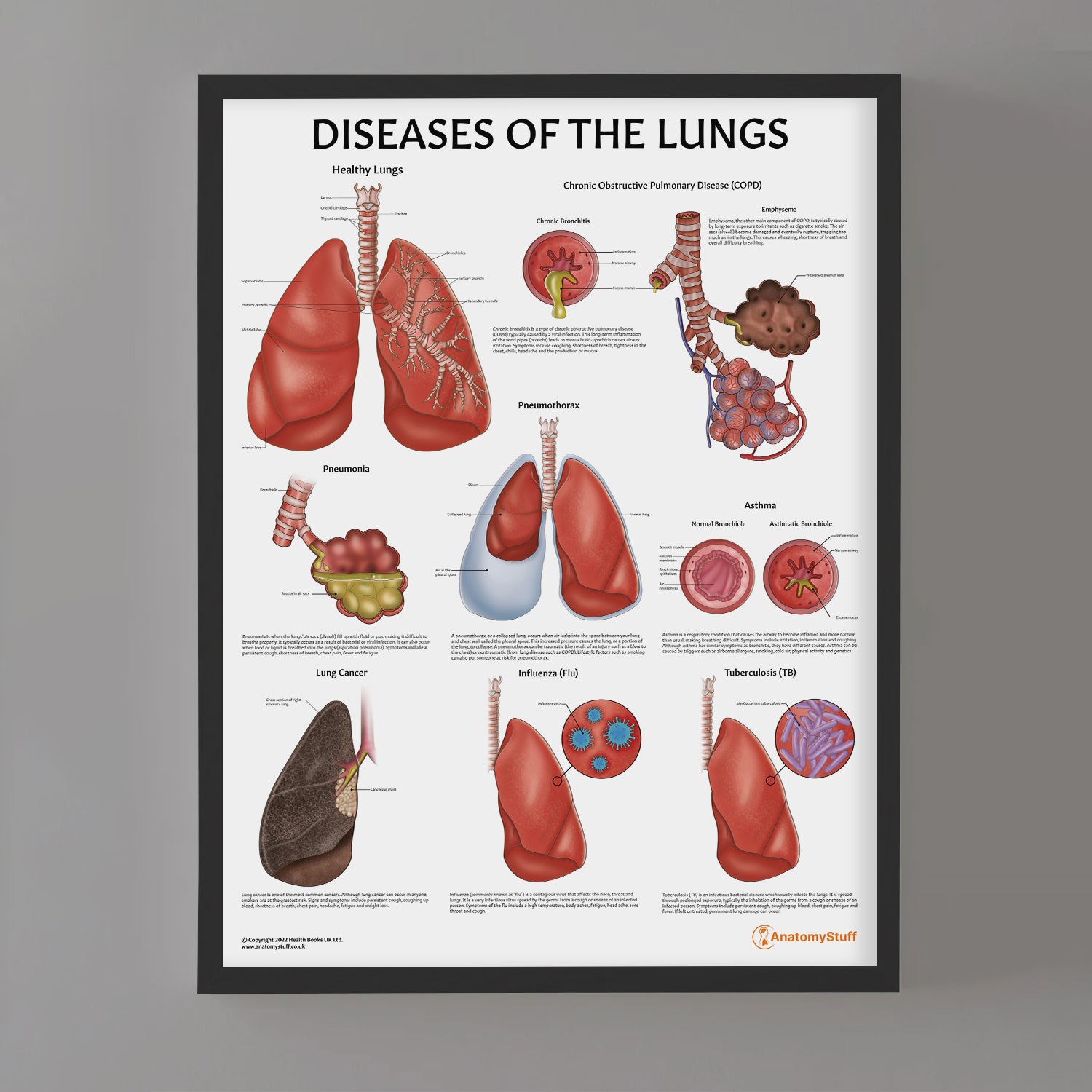 Diseases of the Lungs Chart / Poster