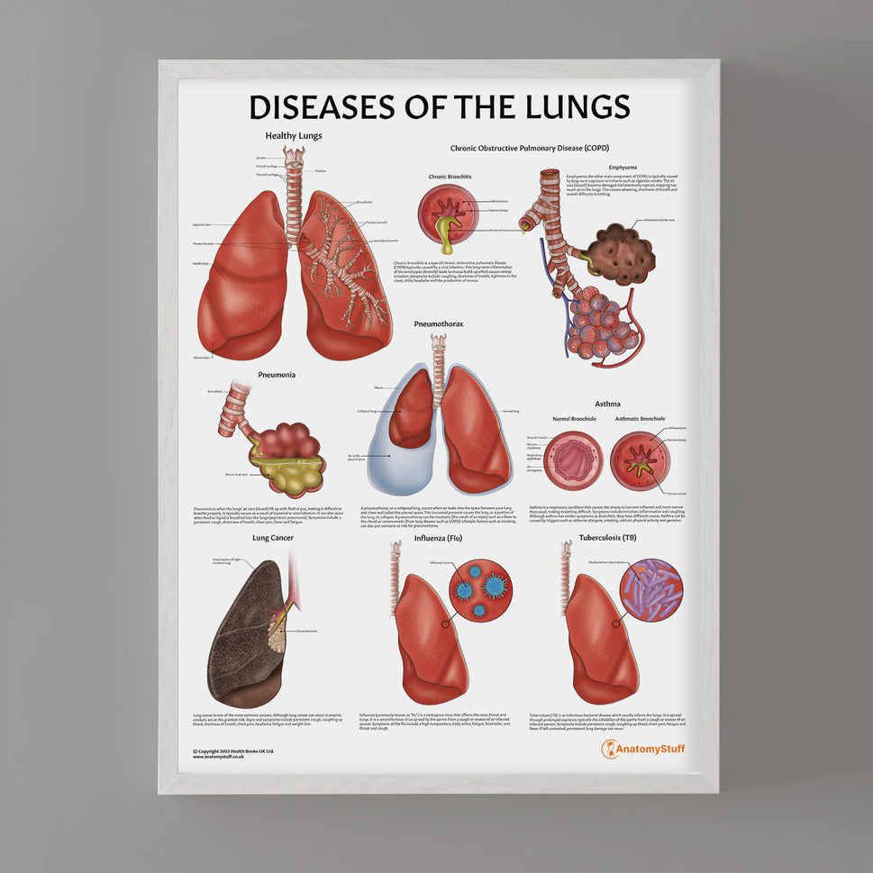 Diseases of the Lungs Chart / Poster