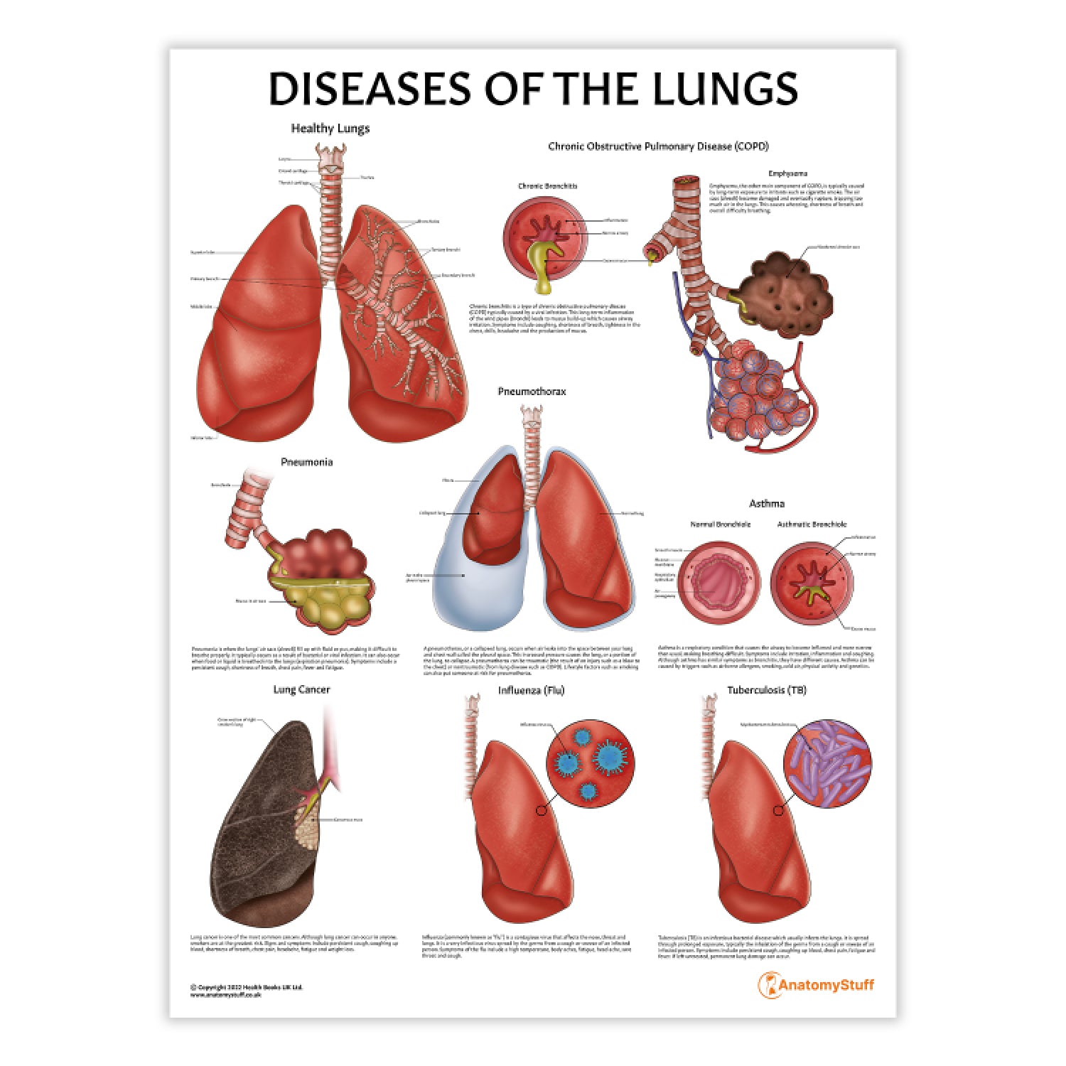 Diseases of the Lungs Chart / Poster