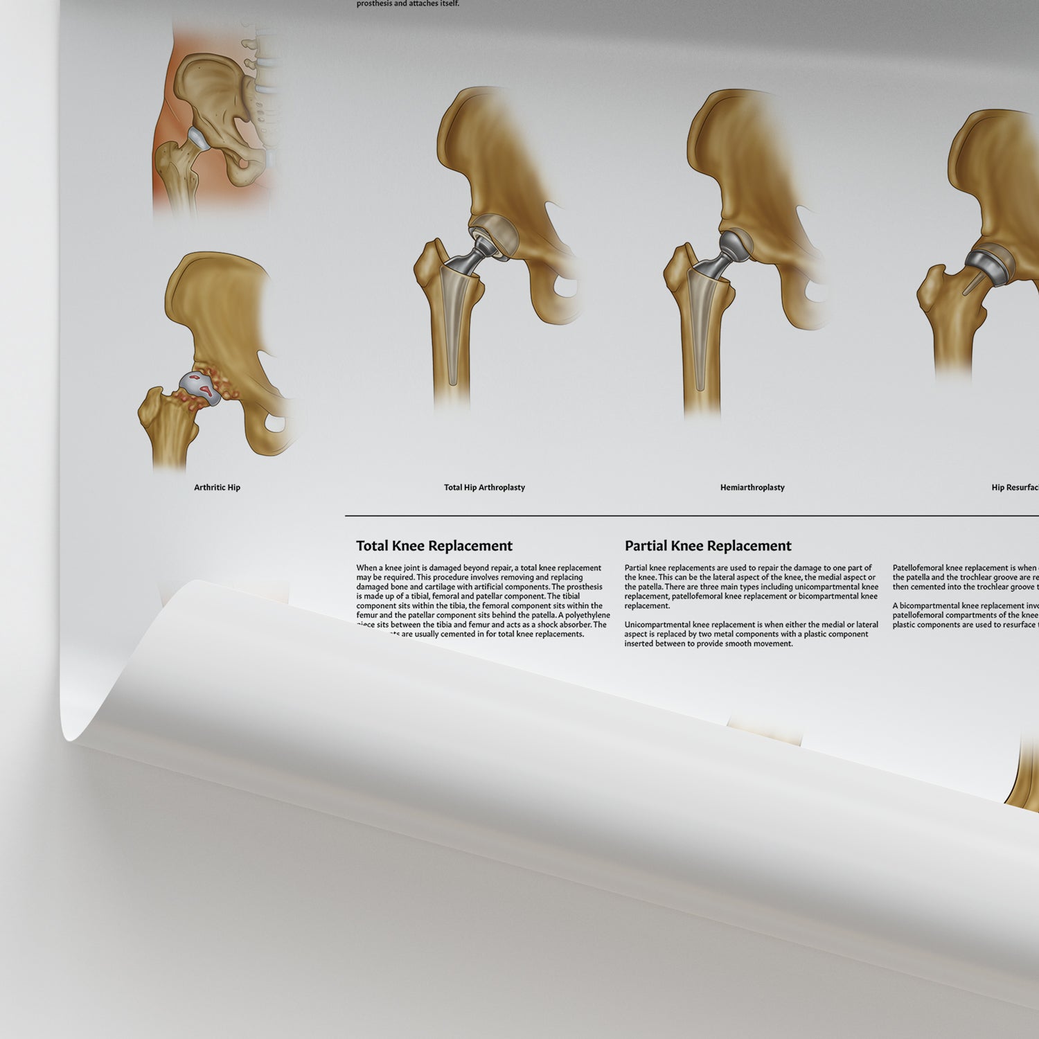 Hip & Knee Replacement Chart / Poster
