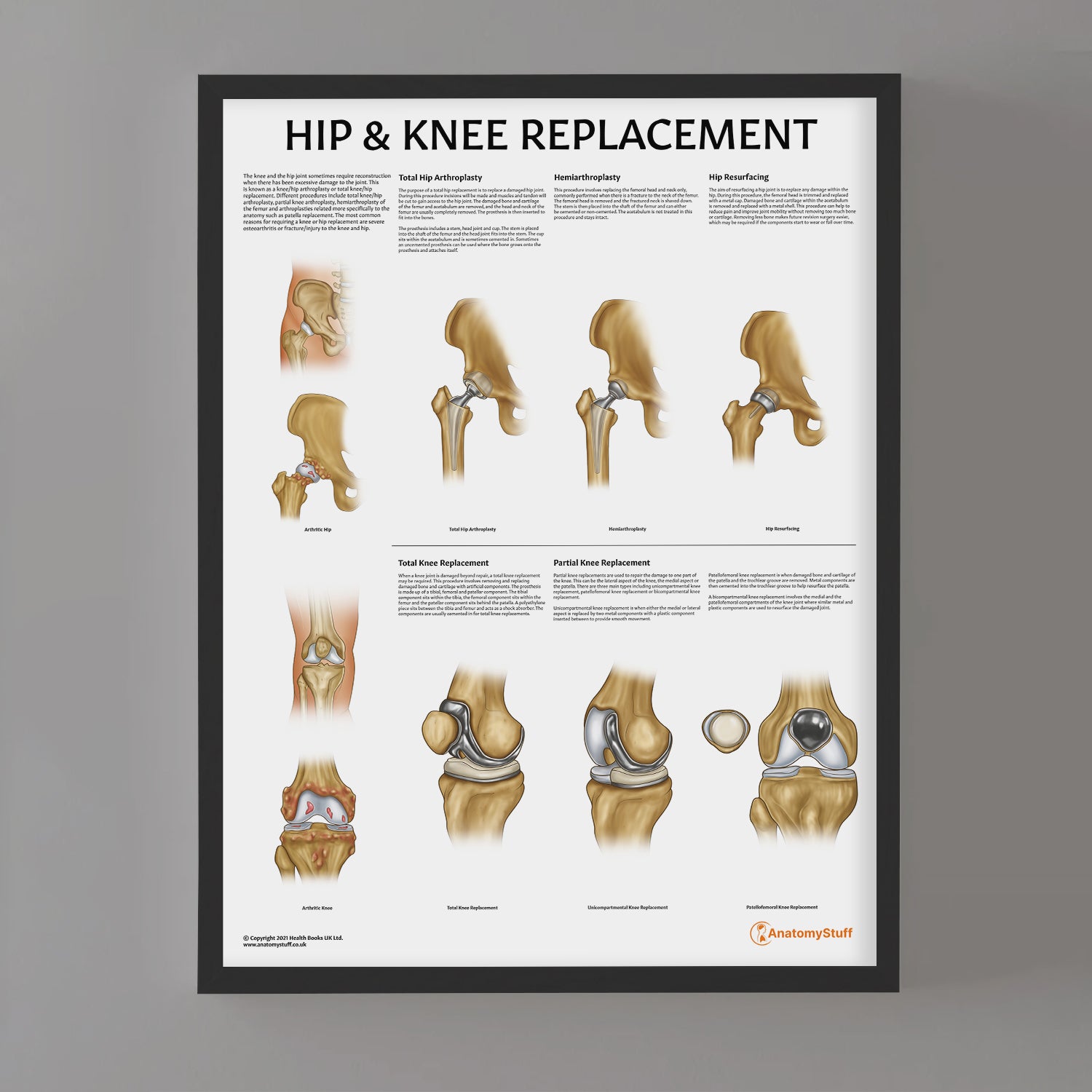 Hip & Knee Replacement Chart / Poster