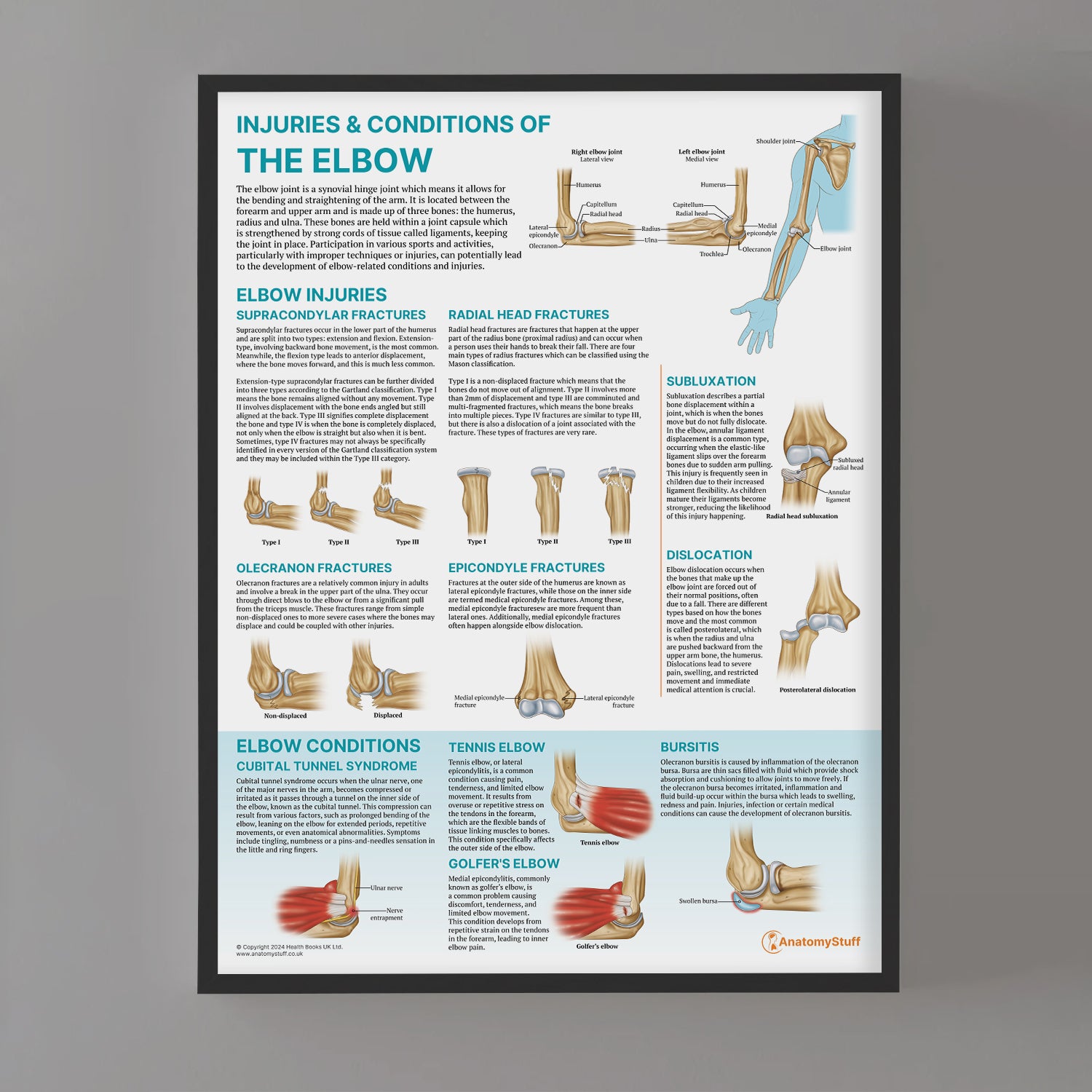 Injuries & Conditions of the Elbow Chart / Poster
