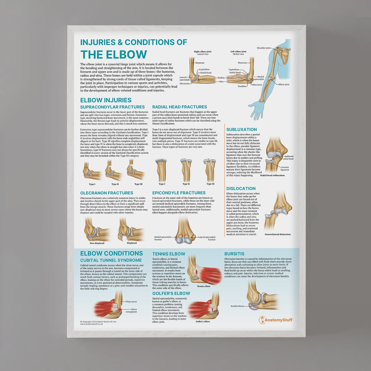 Injuries & Conditions of the Elbow Chart / Poster