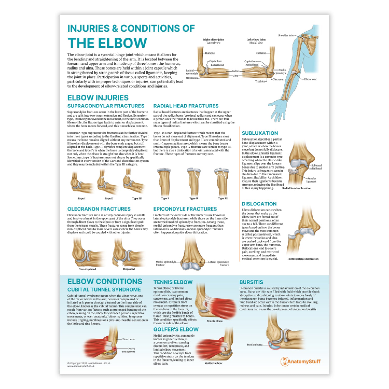 Injuries & Conditions of the Elbow Chart / Poster