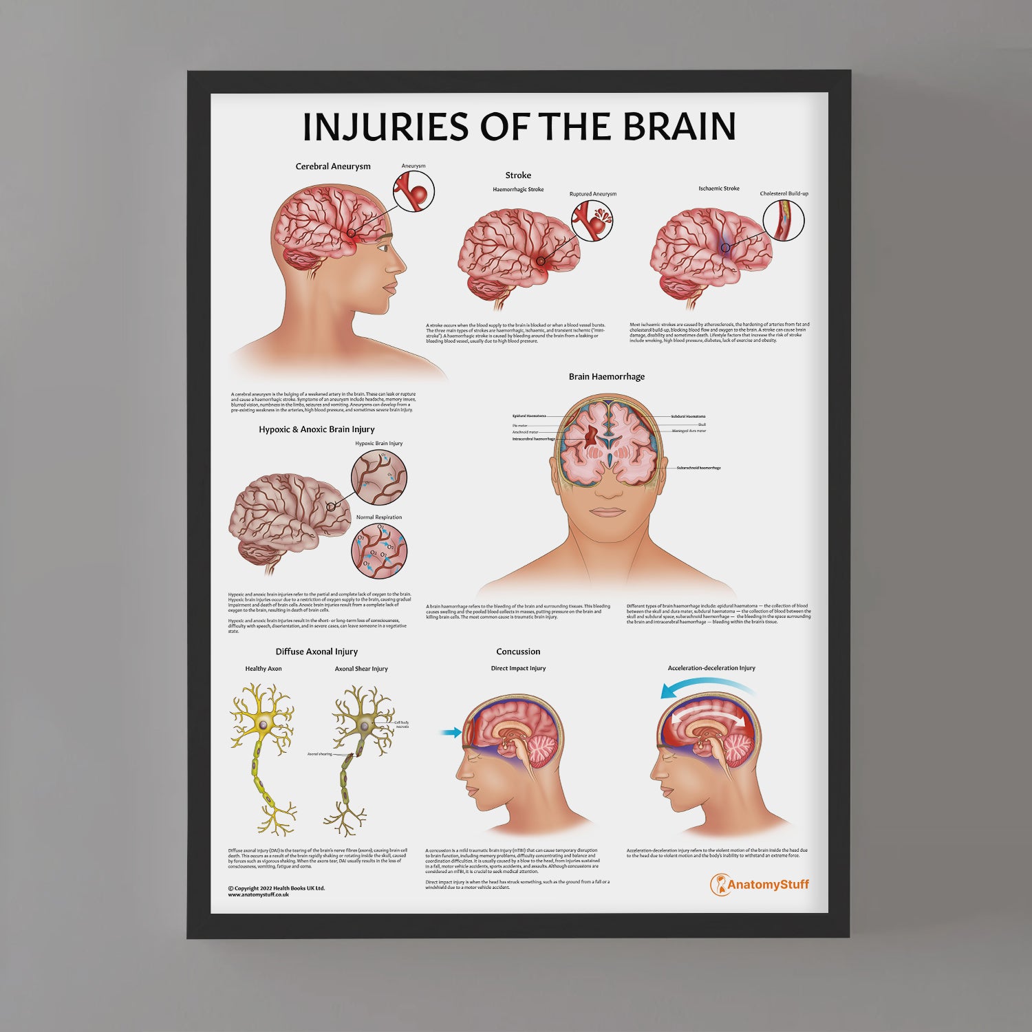 Injuries Of The Brain Chart / Poster