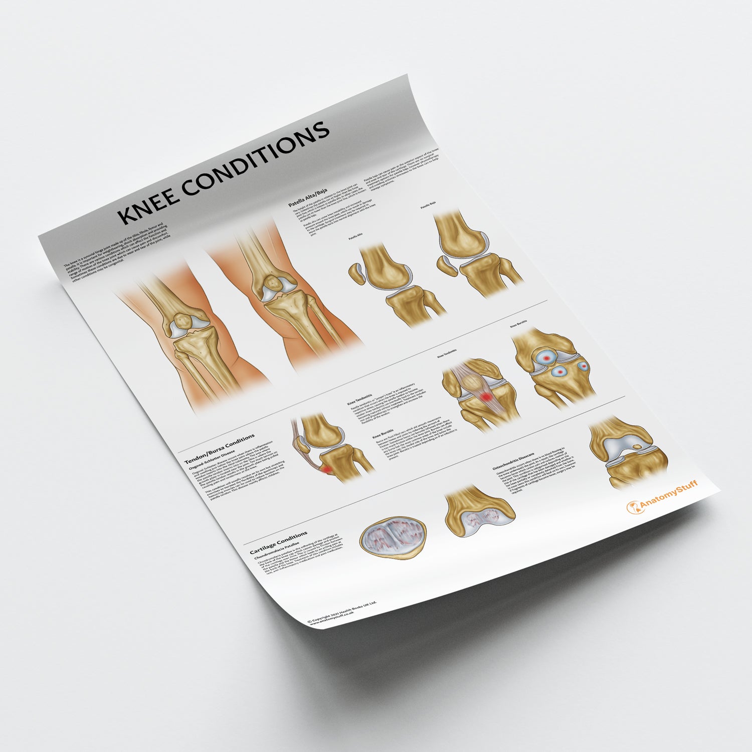 Knee Conditions Chart / Poster