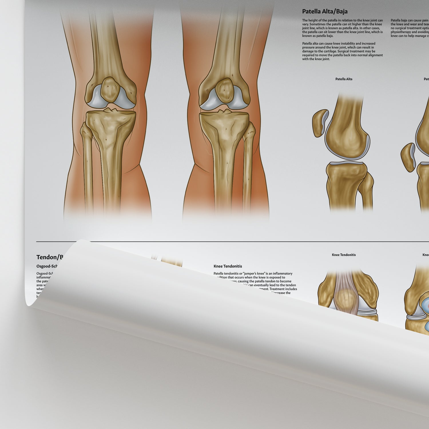 Knee Conditions Chart / Poster