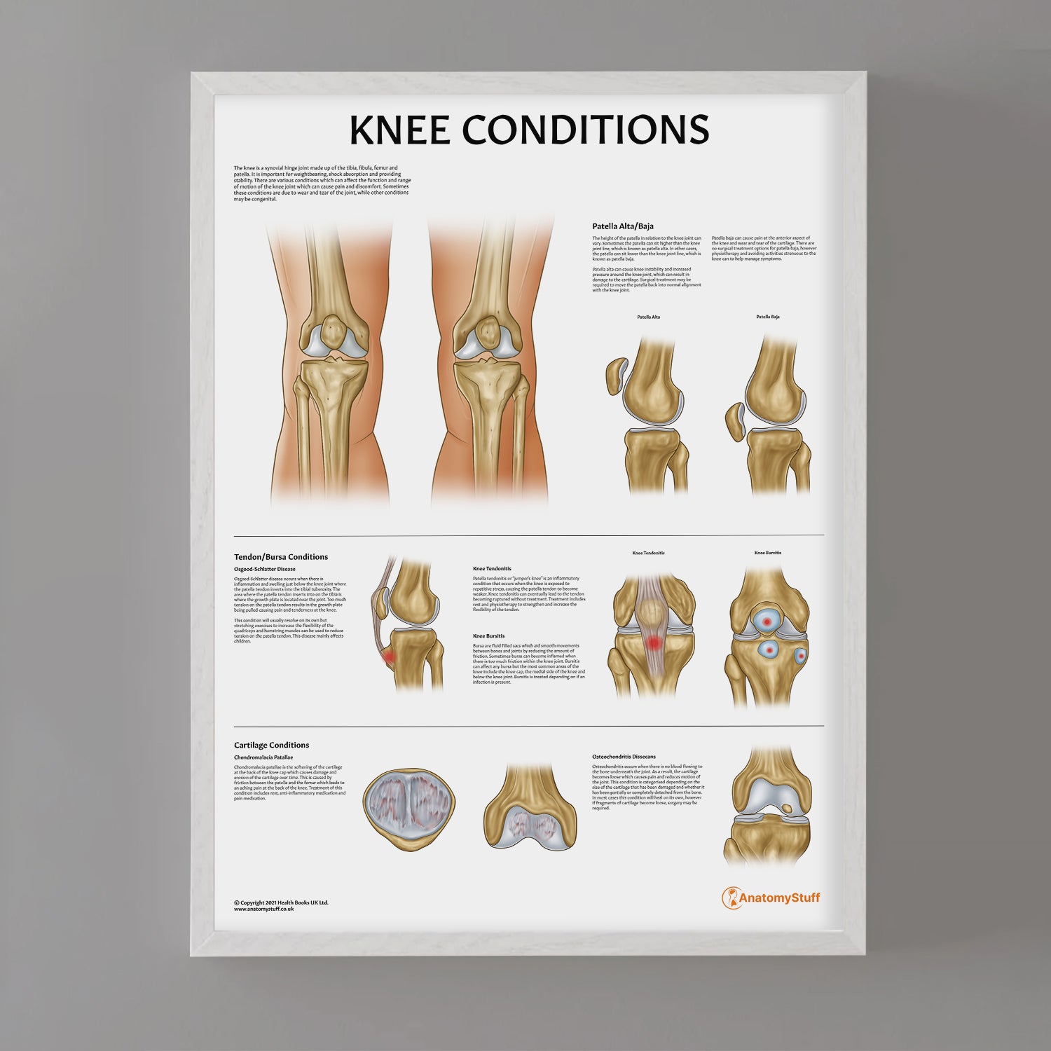 Knee Conditions Chart / Poster