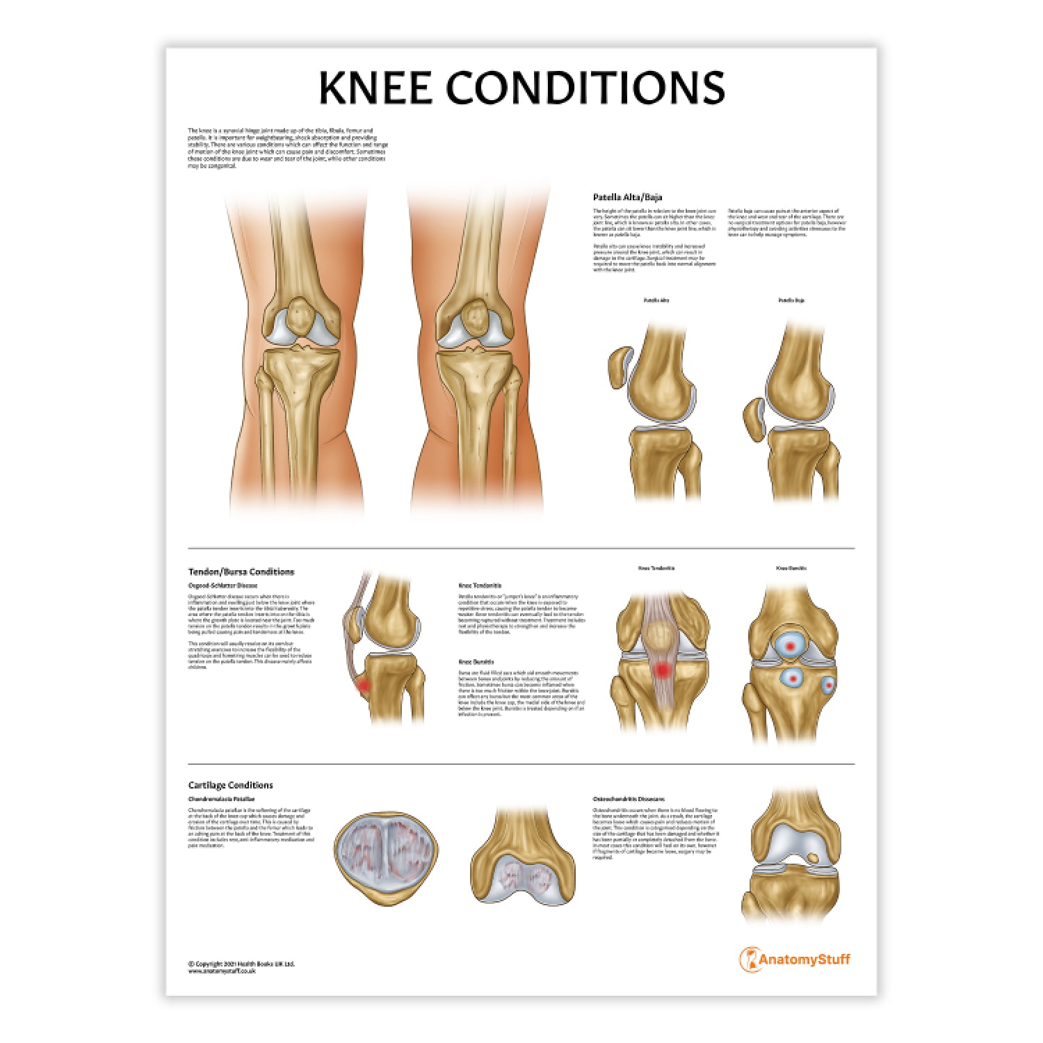 Knee Conditions Chart / Poster
