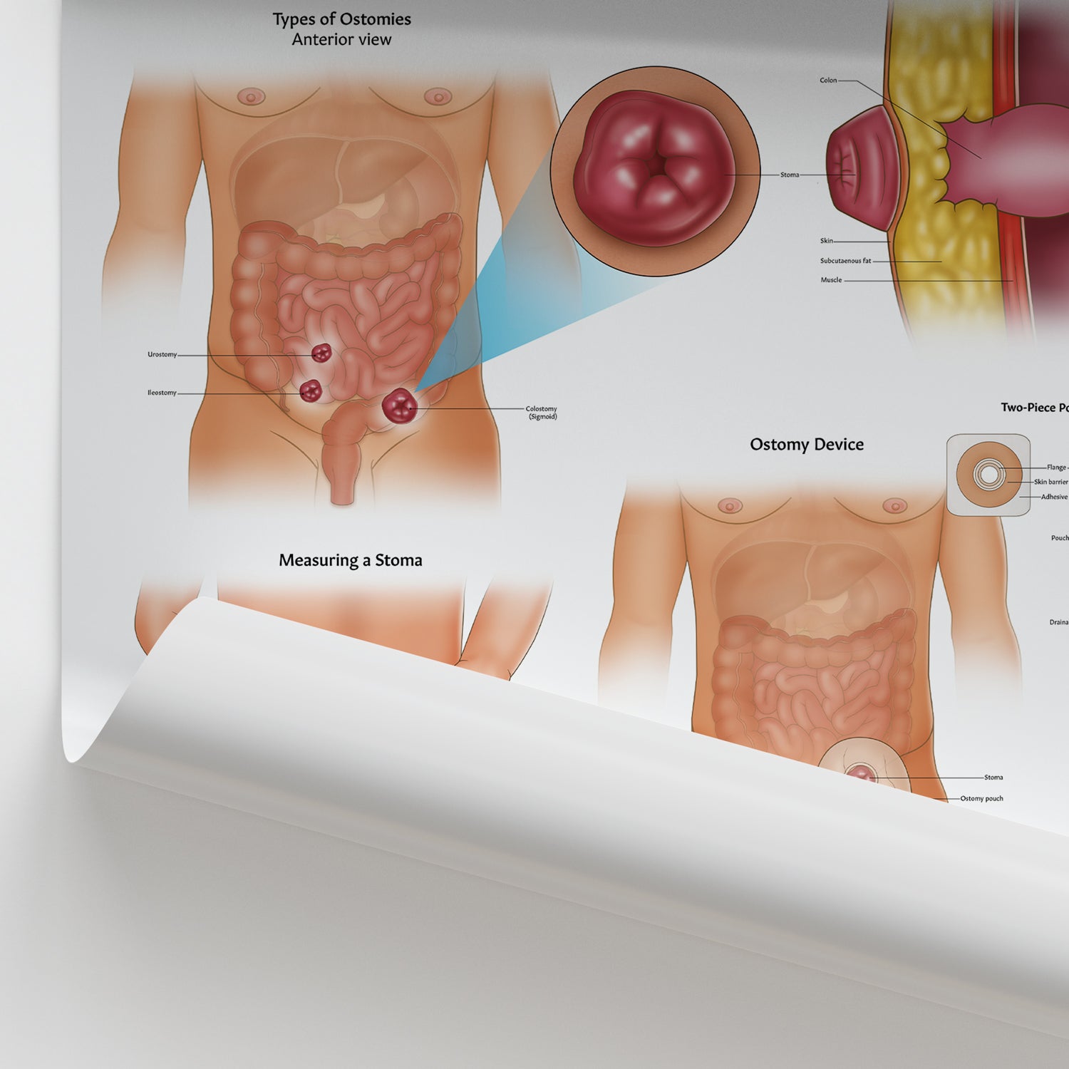 Ostomy Anatomy Chart / Poster