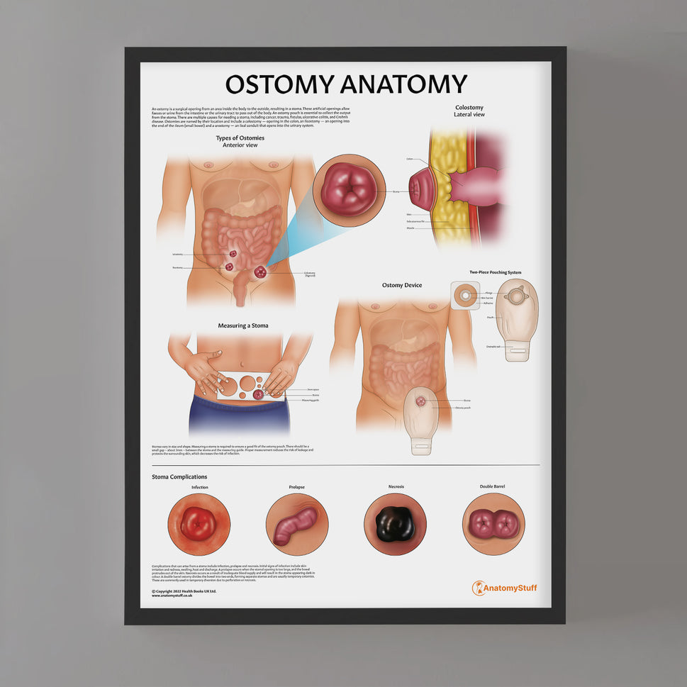 Ostomy Anatomy Chart / Poster
