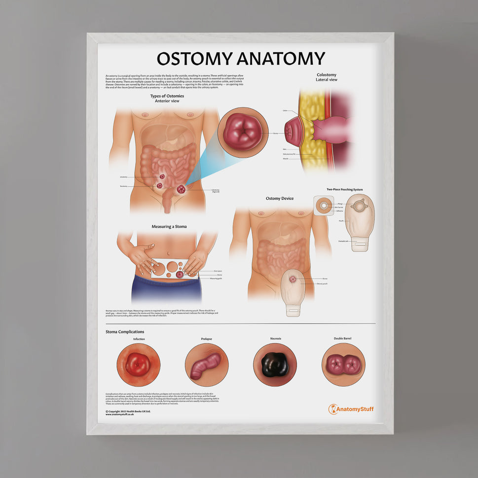 Ostomy Anatomy Chart / Poster