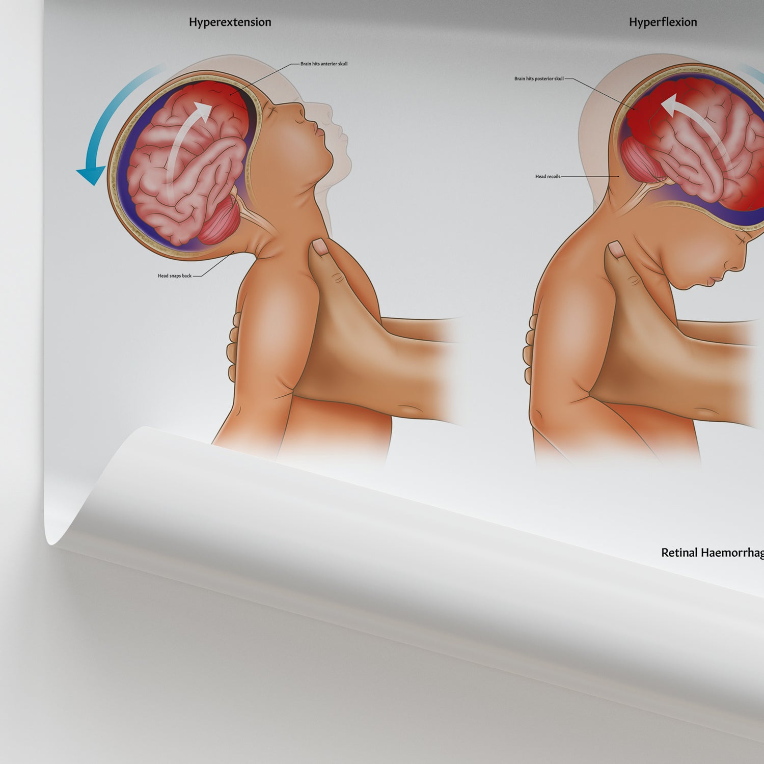 Shaken Baby Syndrome Chart / Poster