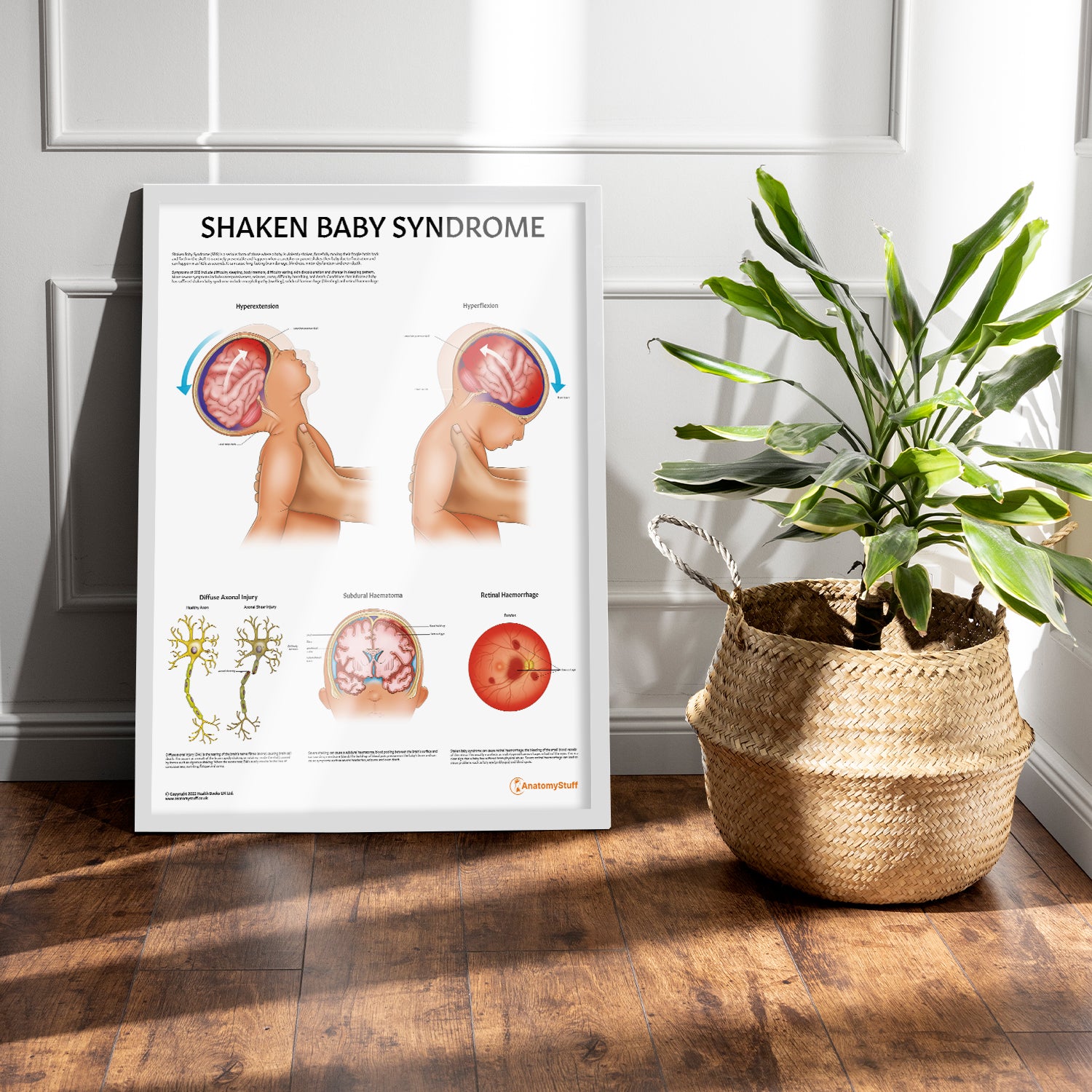 Shaken Baby Syndrome Chart / Poster