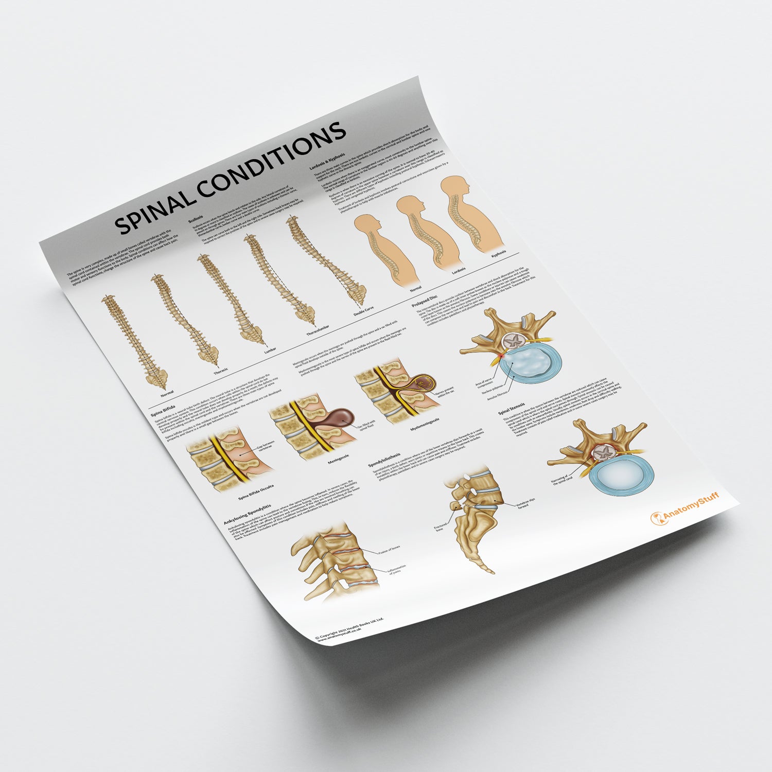 Spinal Conditions Chart / Poster