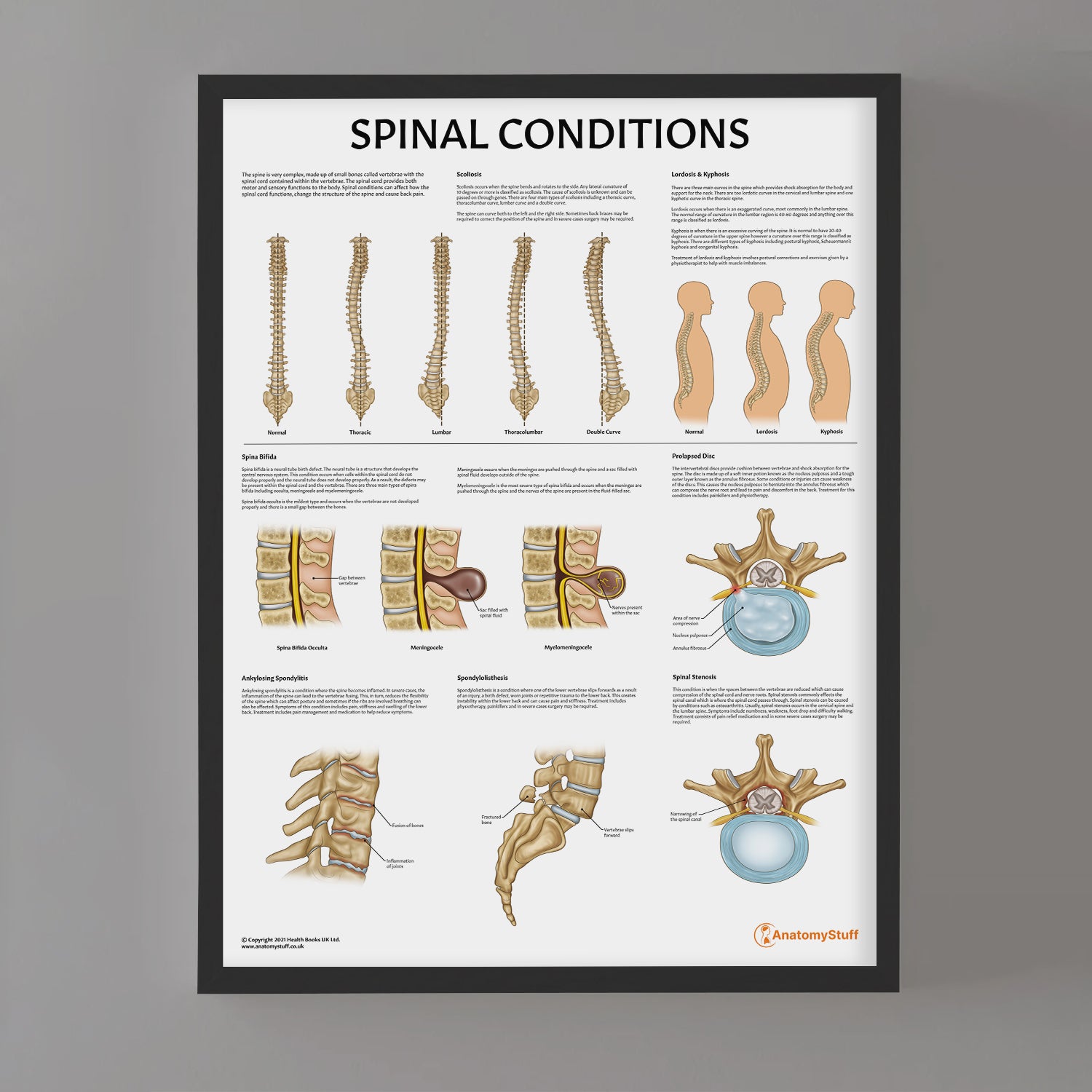 Spinal Conditions Chart / Poster
