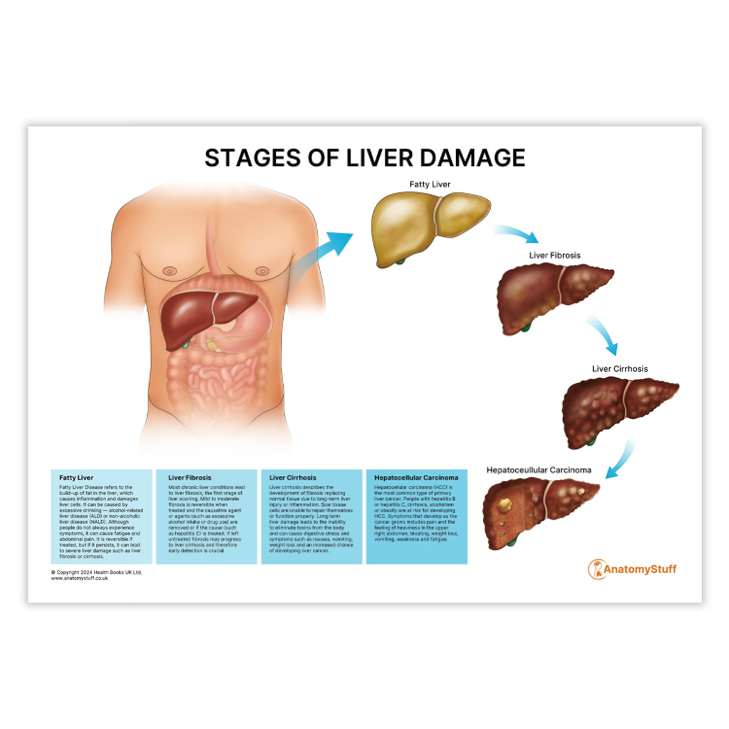 Stages of Liver Damage (Printable PDF)