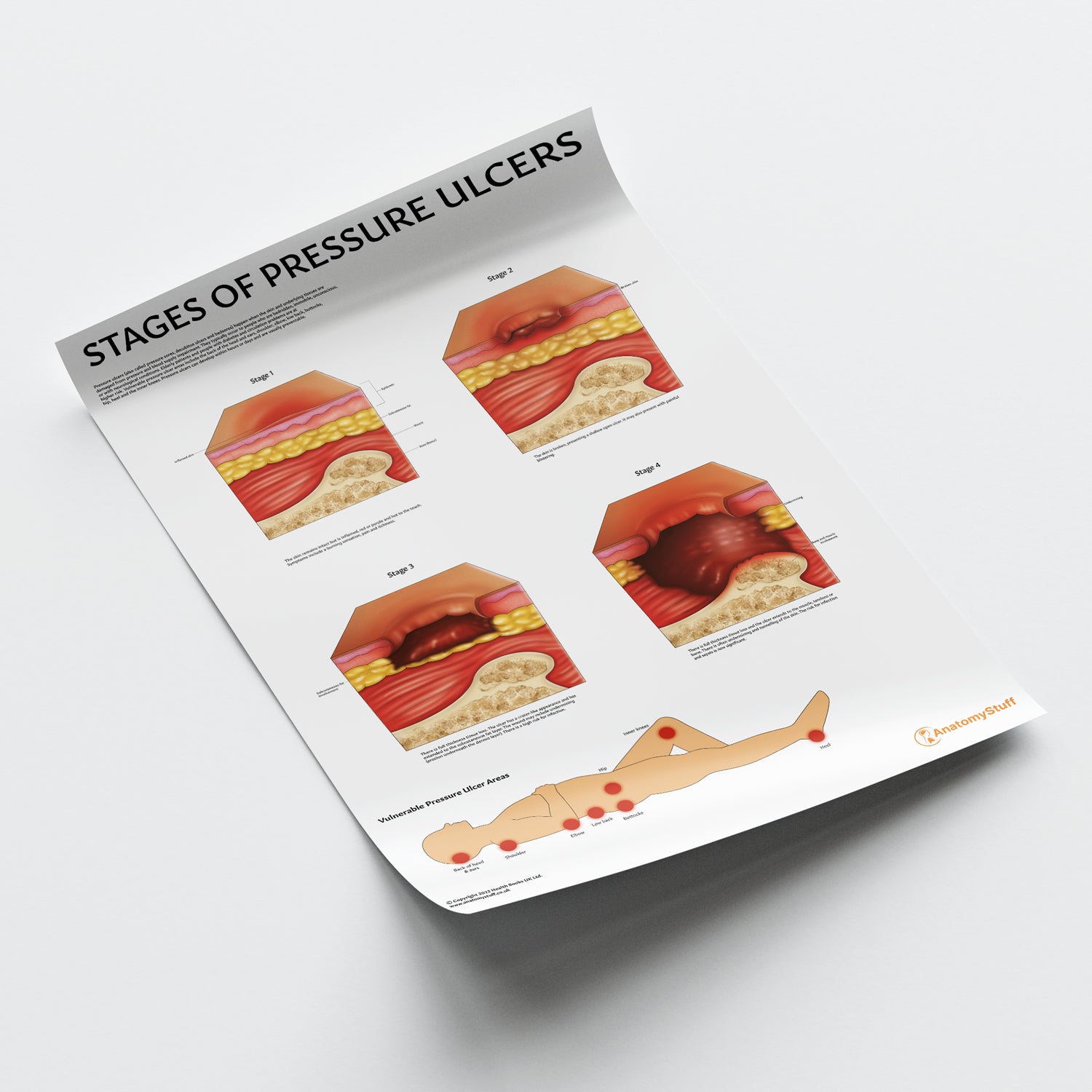 Stages of Pressure Ulcers Chart / Poster