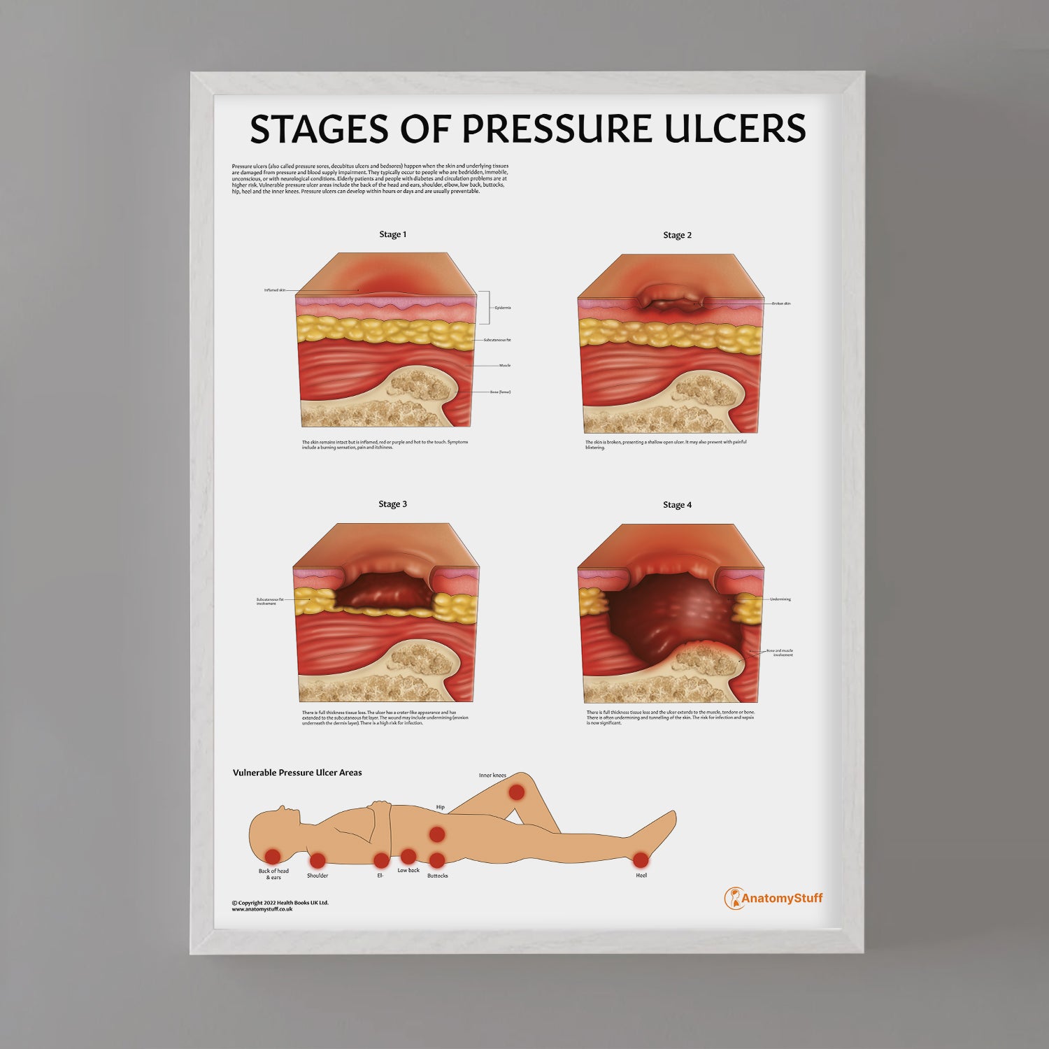 Stages of Pressure Ulcers Chart / Poster