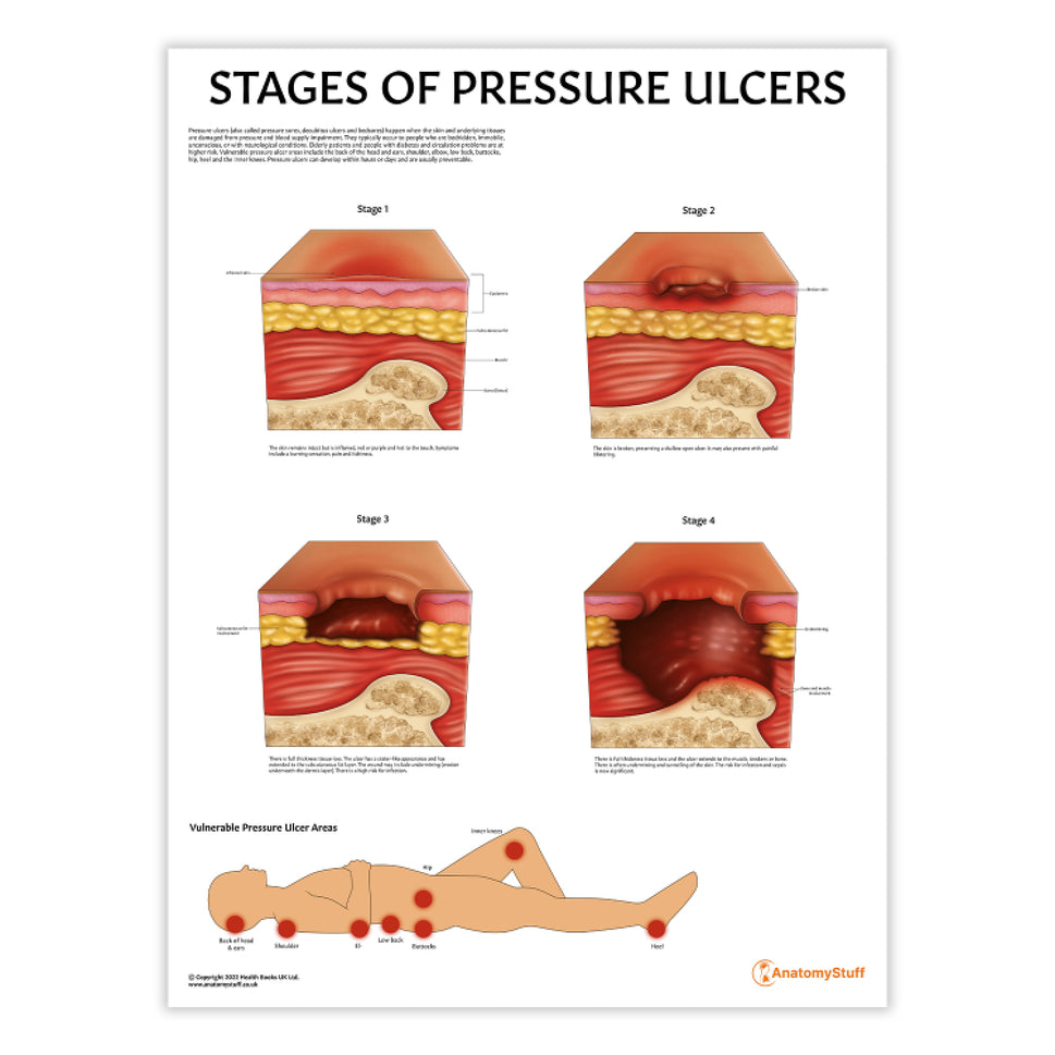 Stages of Pressure Ulcers Chart / Poster