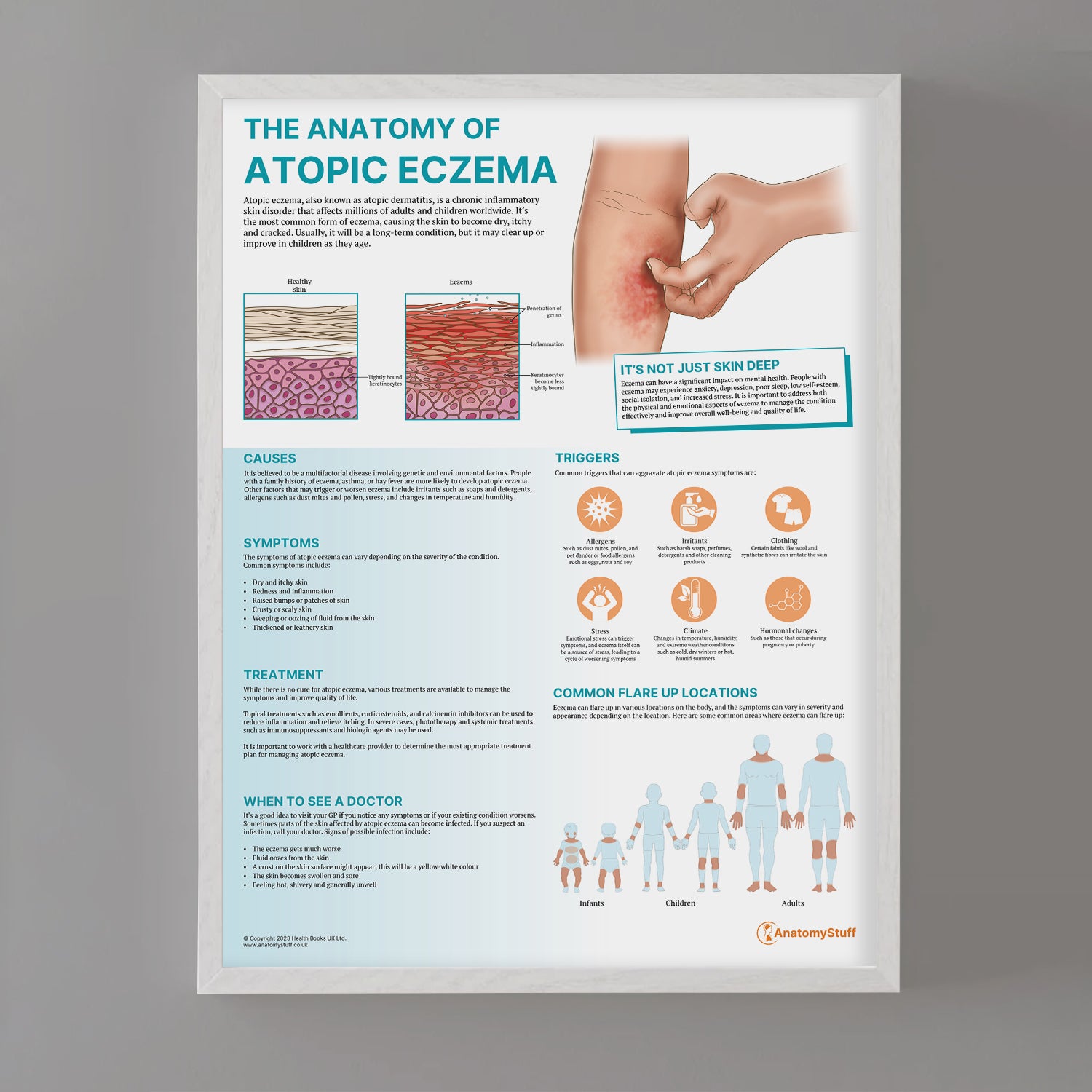 The Anatomy of Atopic Eczema Chart / Poster