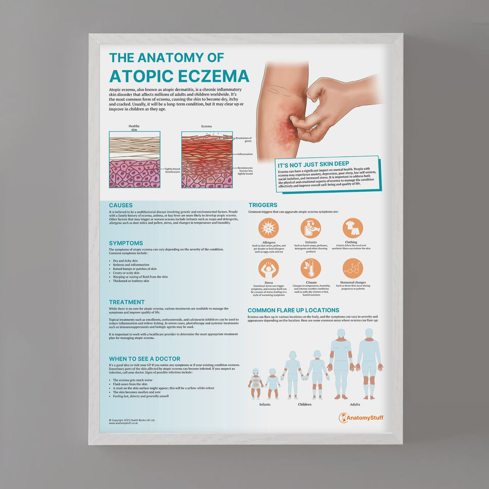 The Anatomy of Atopic Eczema Chart / Poster