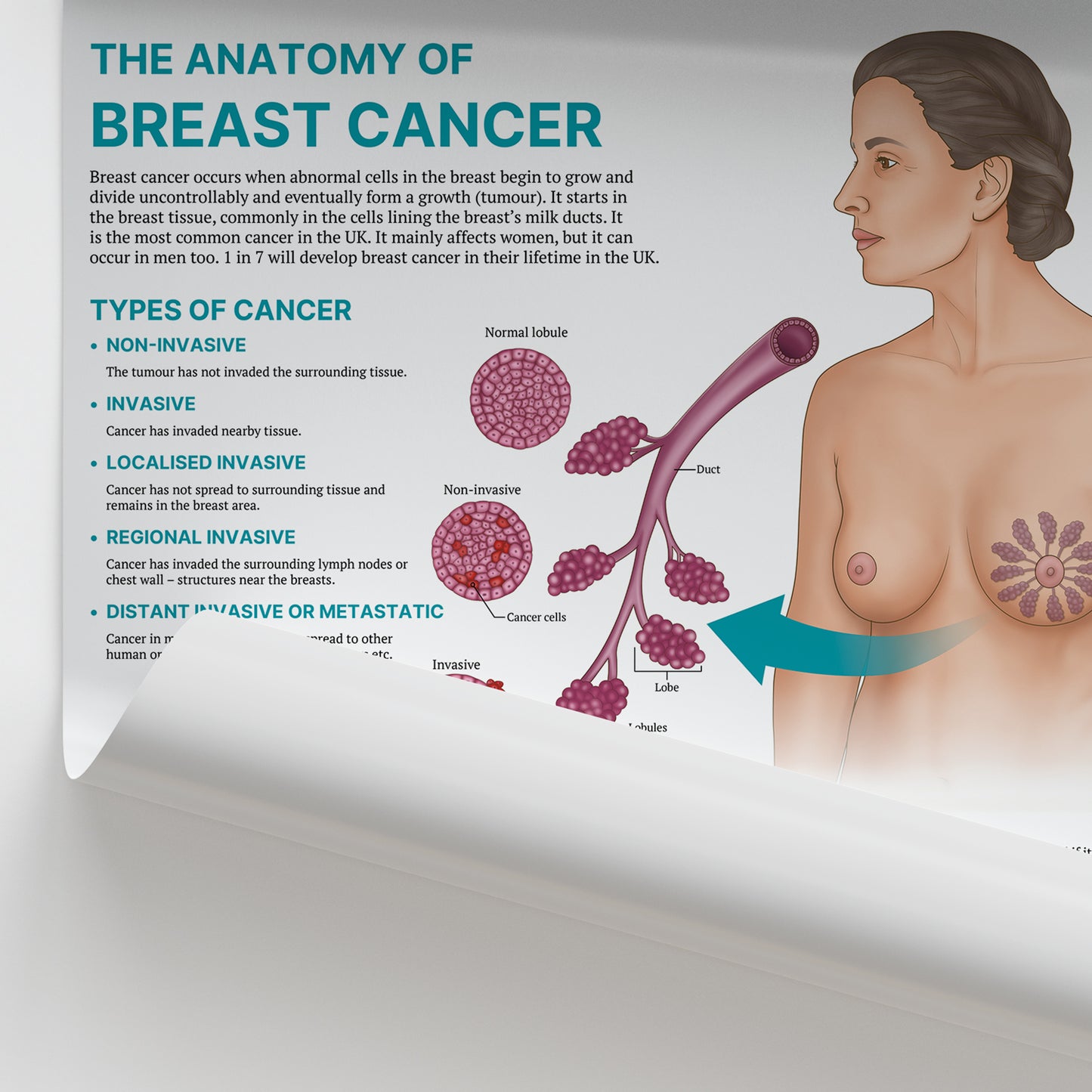 The Anatomy of Breast Cancer Chart / Poster