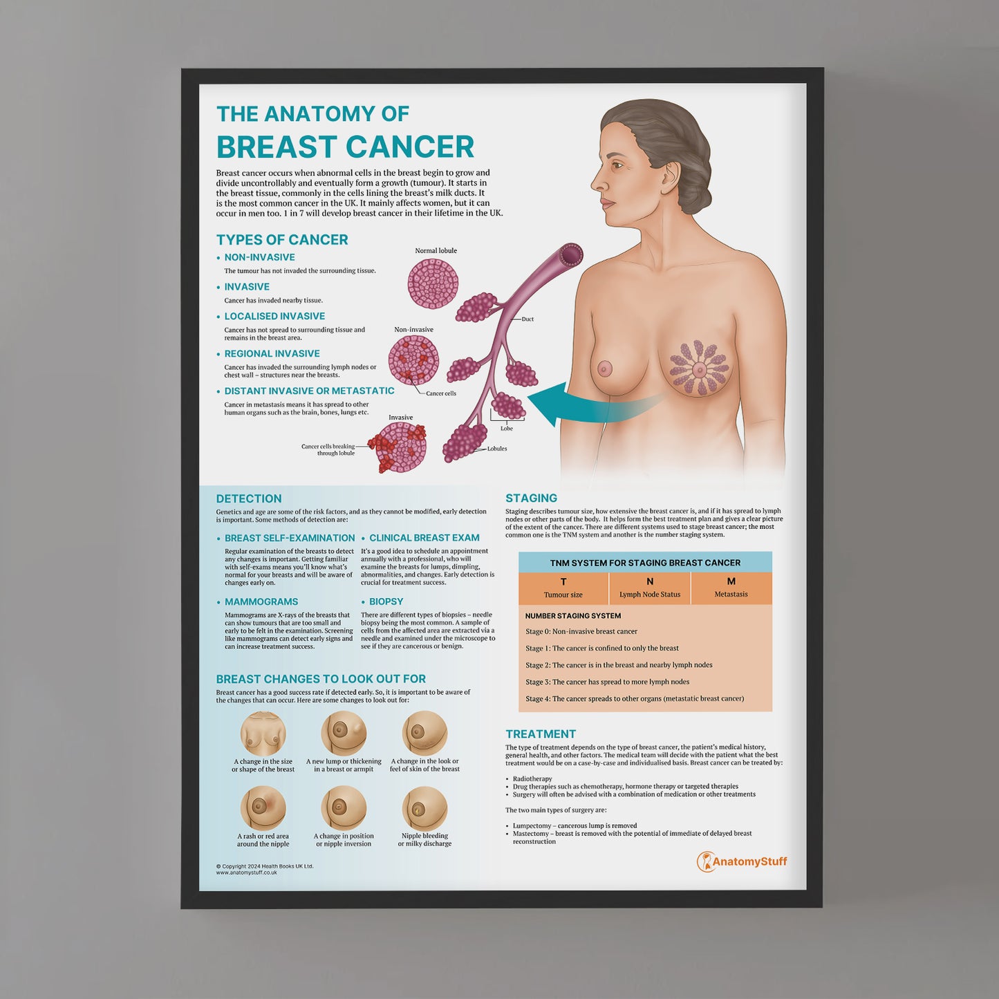 The Anatomy of Breast Cancer Chart / Poster