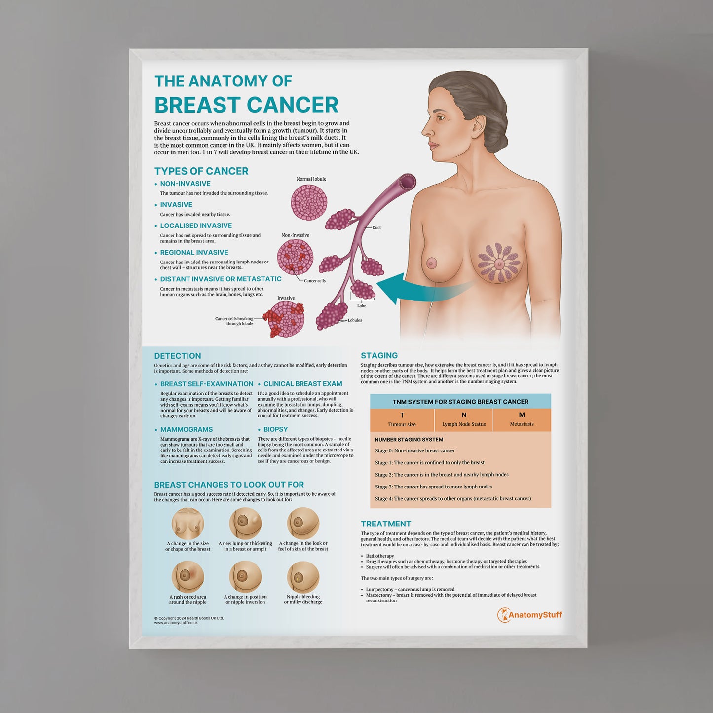 The Anatomy of Breast Cancer Chart / Poster