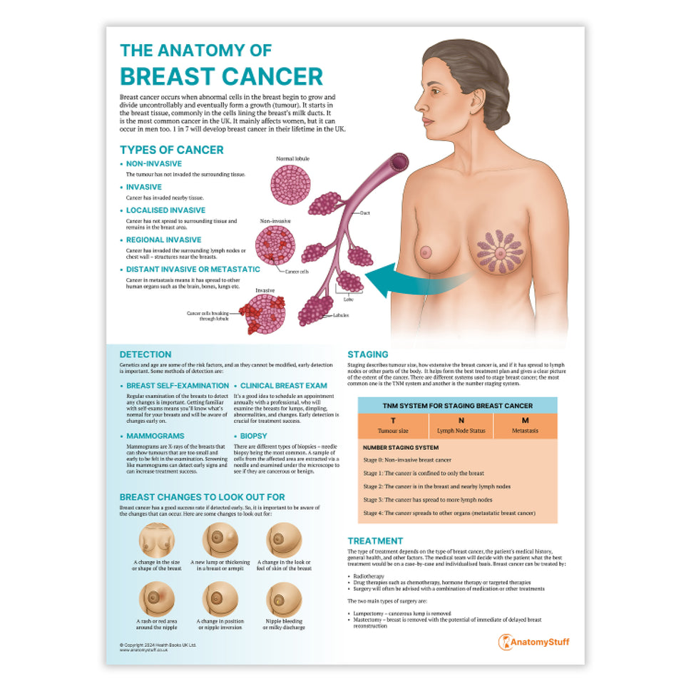 The Anatomy of Breast Cancer Chart / Poster